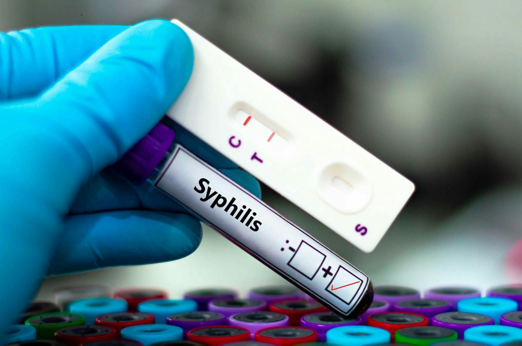 In 2022, the CDC reported a 60-year high of over 207,000 syphilis cases in the US. | image credit: kitsawet / stock.adobe.com