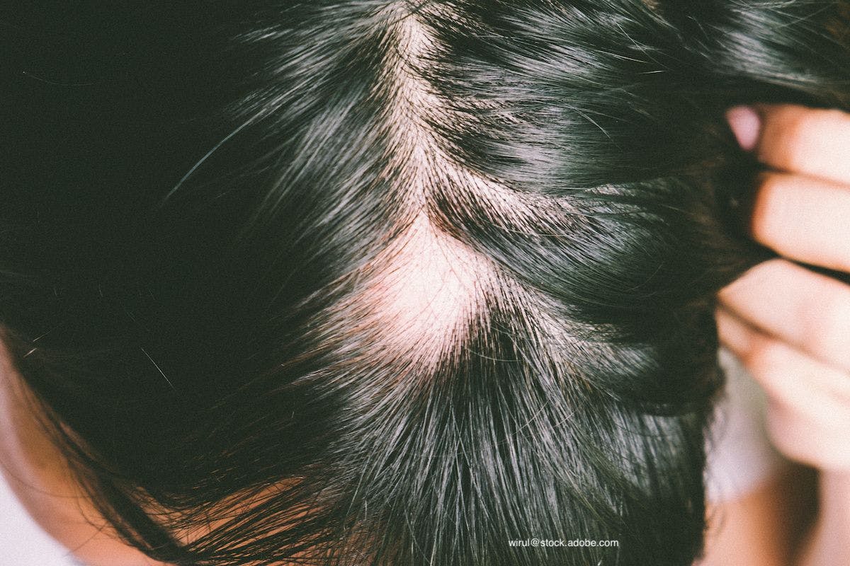 What's New in Alopecia Areata Management