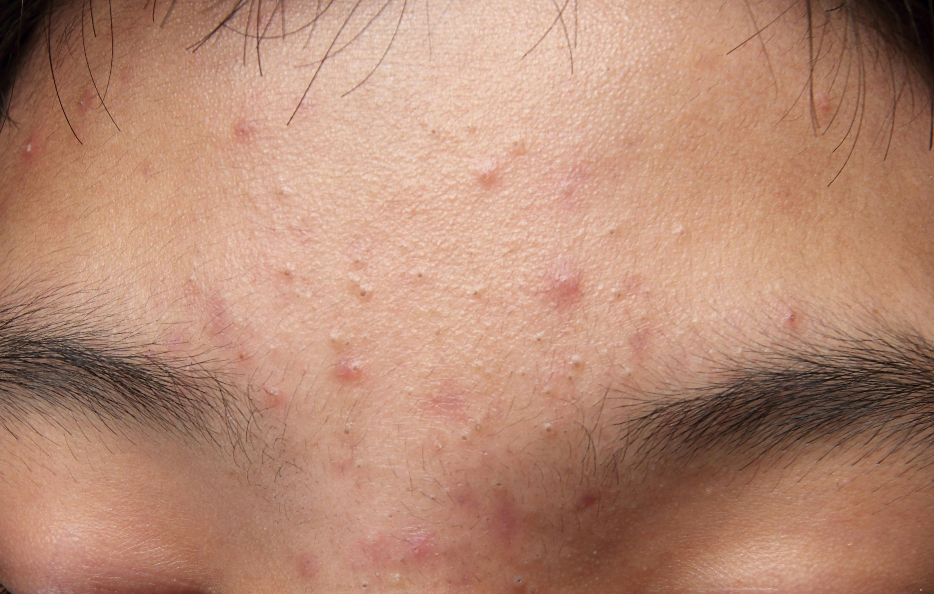 Bacterial Resistance Risk With Systemic Antibiotic Use for Acne