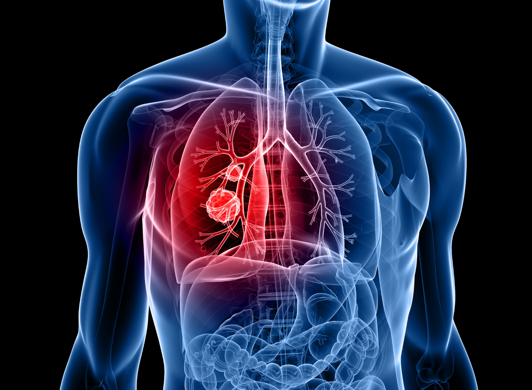 Immunotherapy-Induced Pneumonitis Common in Patients With NSCLC
