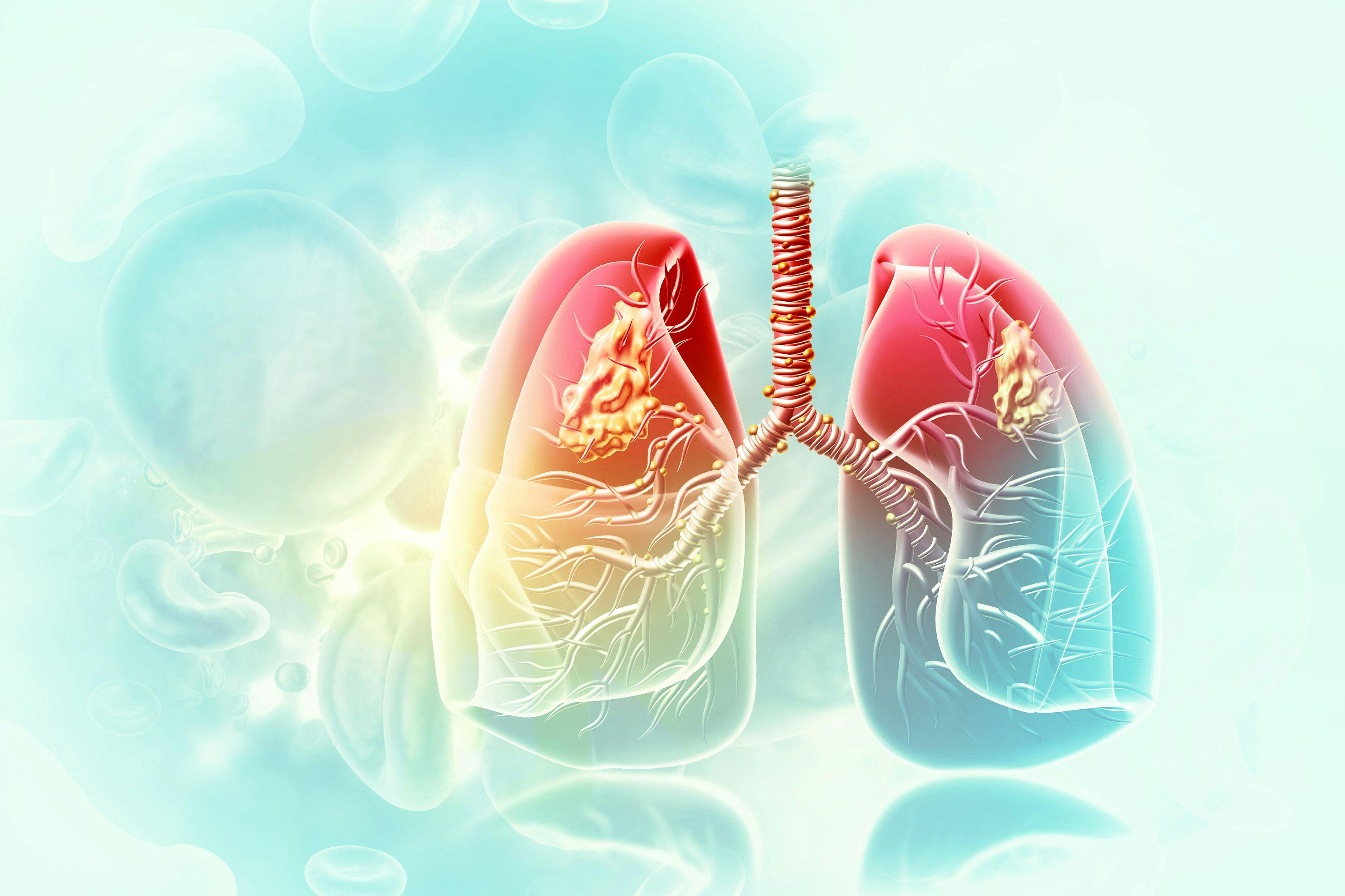 Amivantimab-vmjw was approved to treat patients with NSCLC with certain characteristics. | image credit: Crystal Light - stock.adobe.com