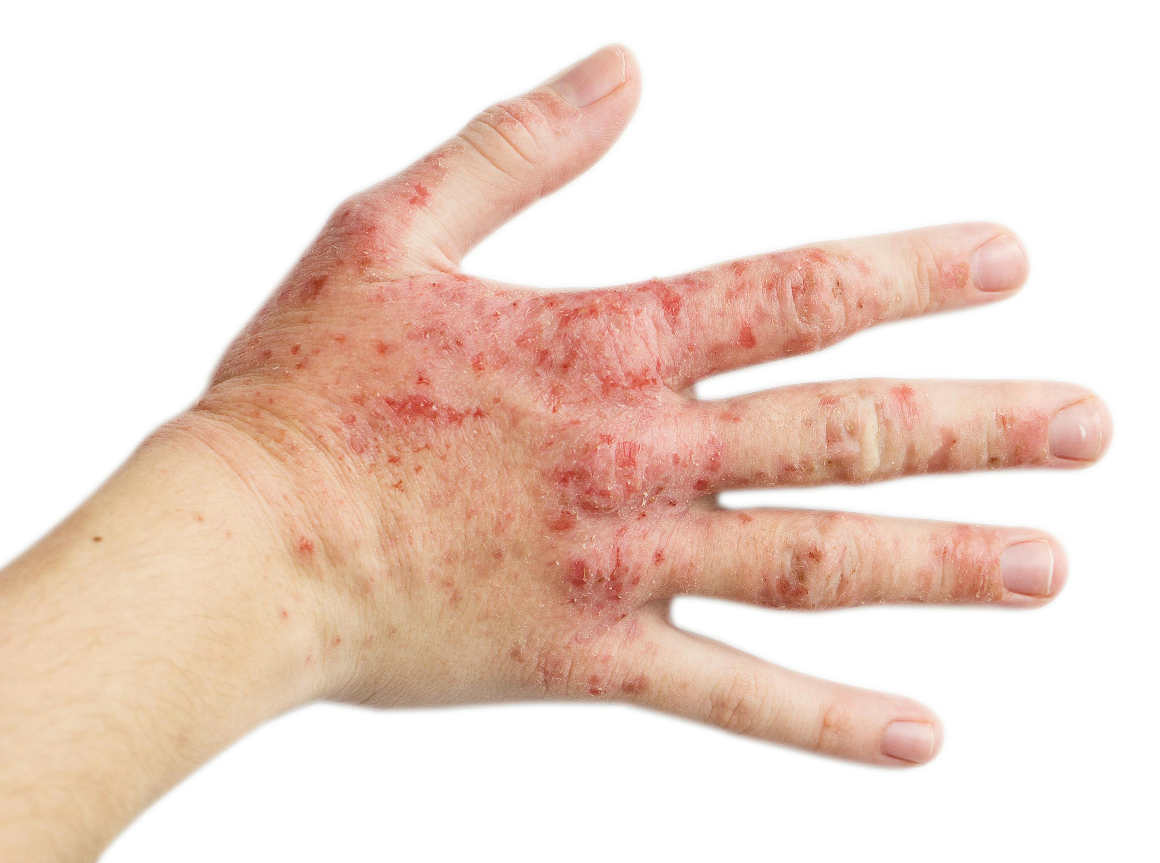 Upadacitinib Approved for Moderate to Severe Atopic Dermatitis