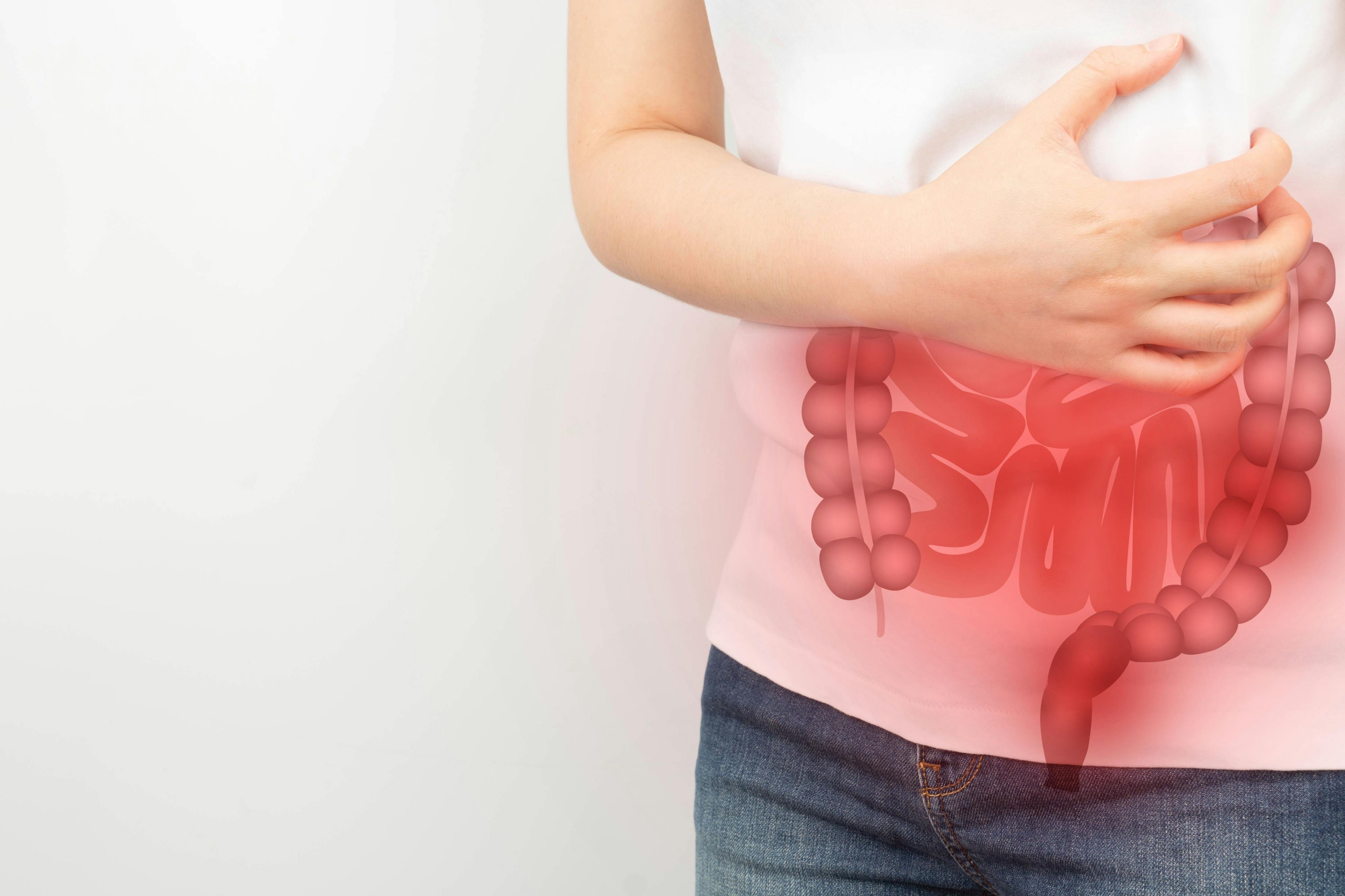 Oral Etrasimod Approved for Moderately to Severely Active Ulcerative Colitis 