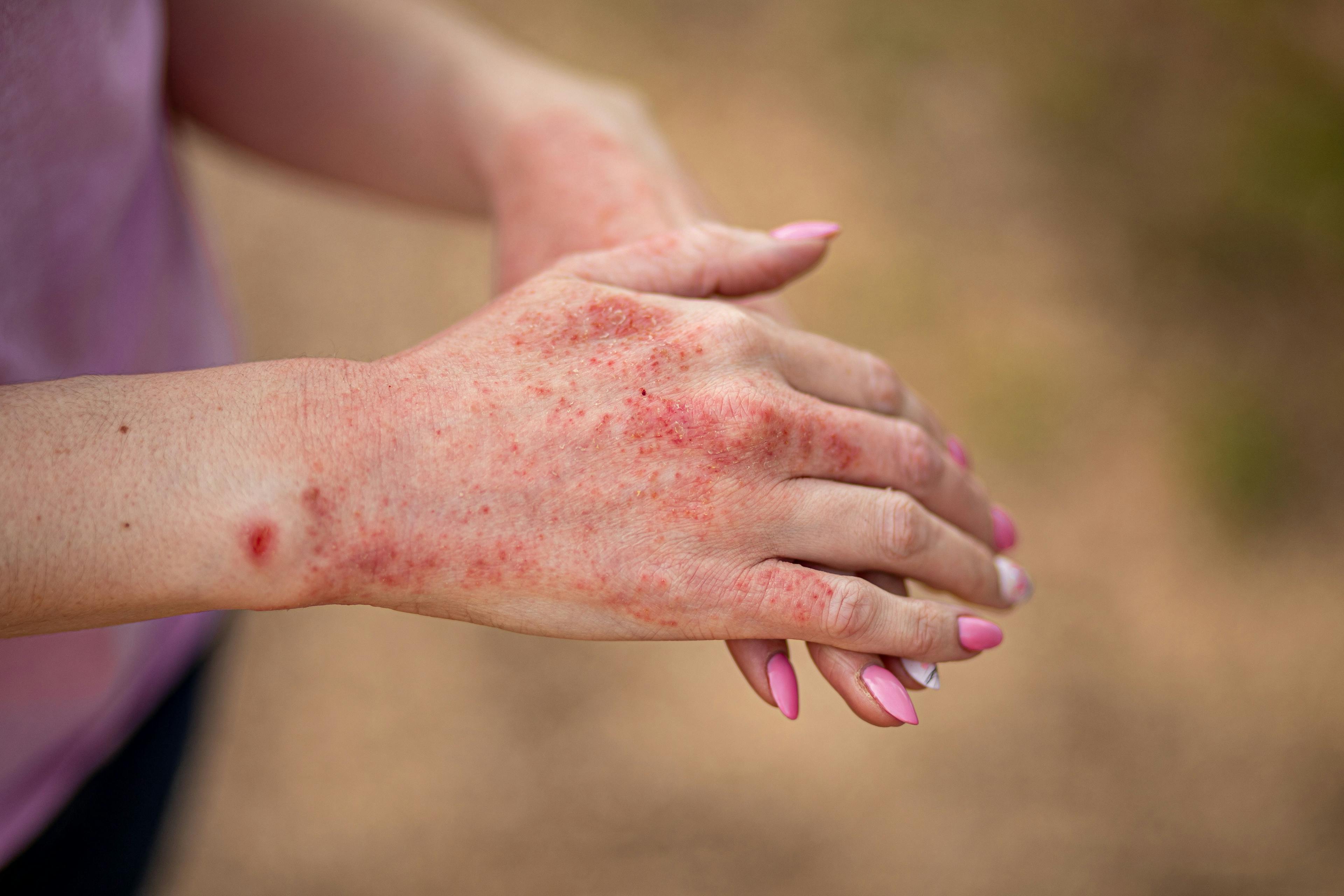 The Effects of Probiotics on Atopic Dermatitis in Children 