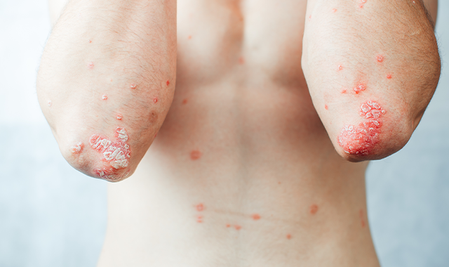 Body with Psoriasis