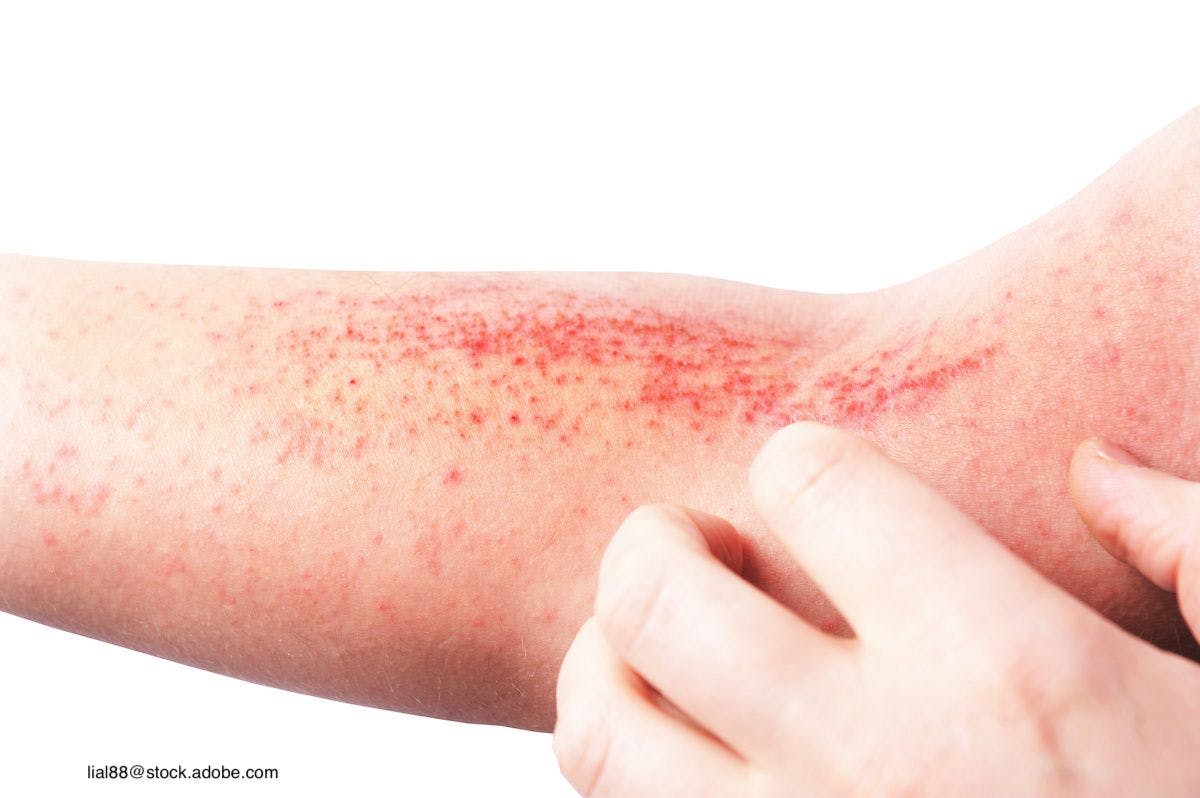 An Abundance of Options for Treating Atopic Dermatitis
