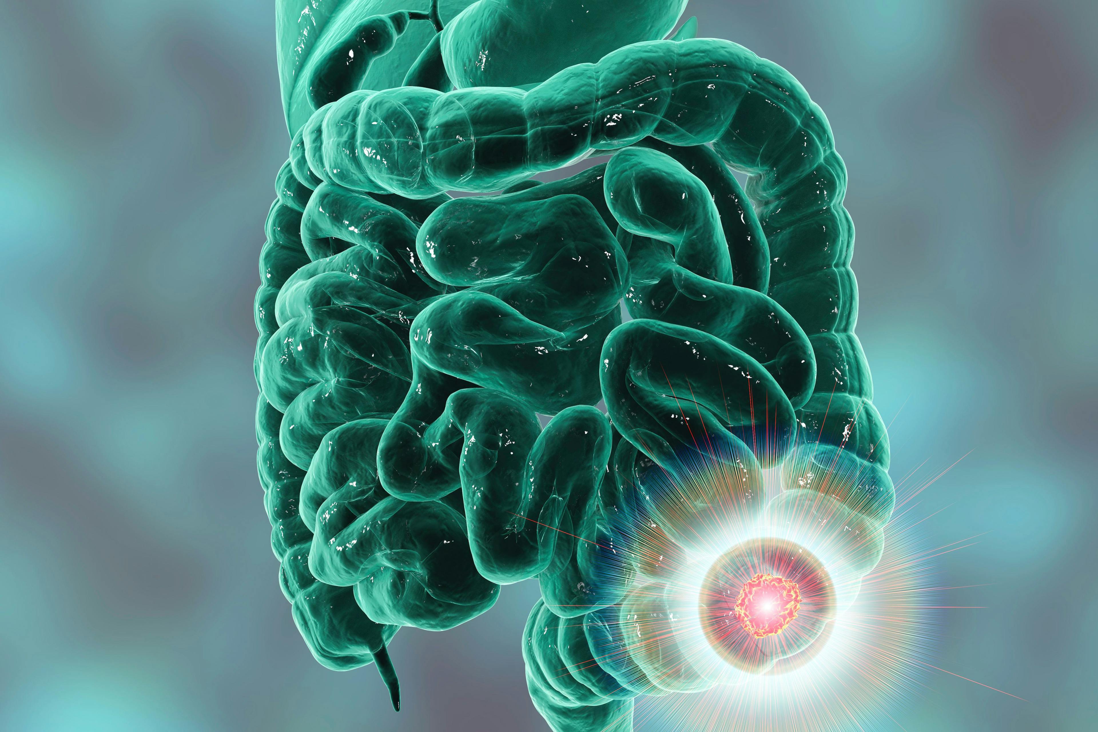 Colorectal cancer is the second leading cause of cancer-related death in the US, with 53,000 patients expected to die from from the disease in 2024 alone / Dr. Microbe - stock.adobe.com