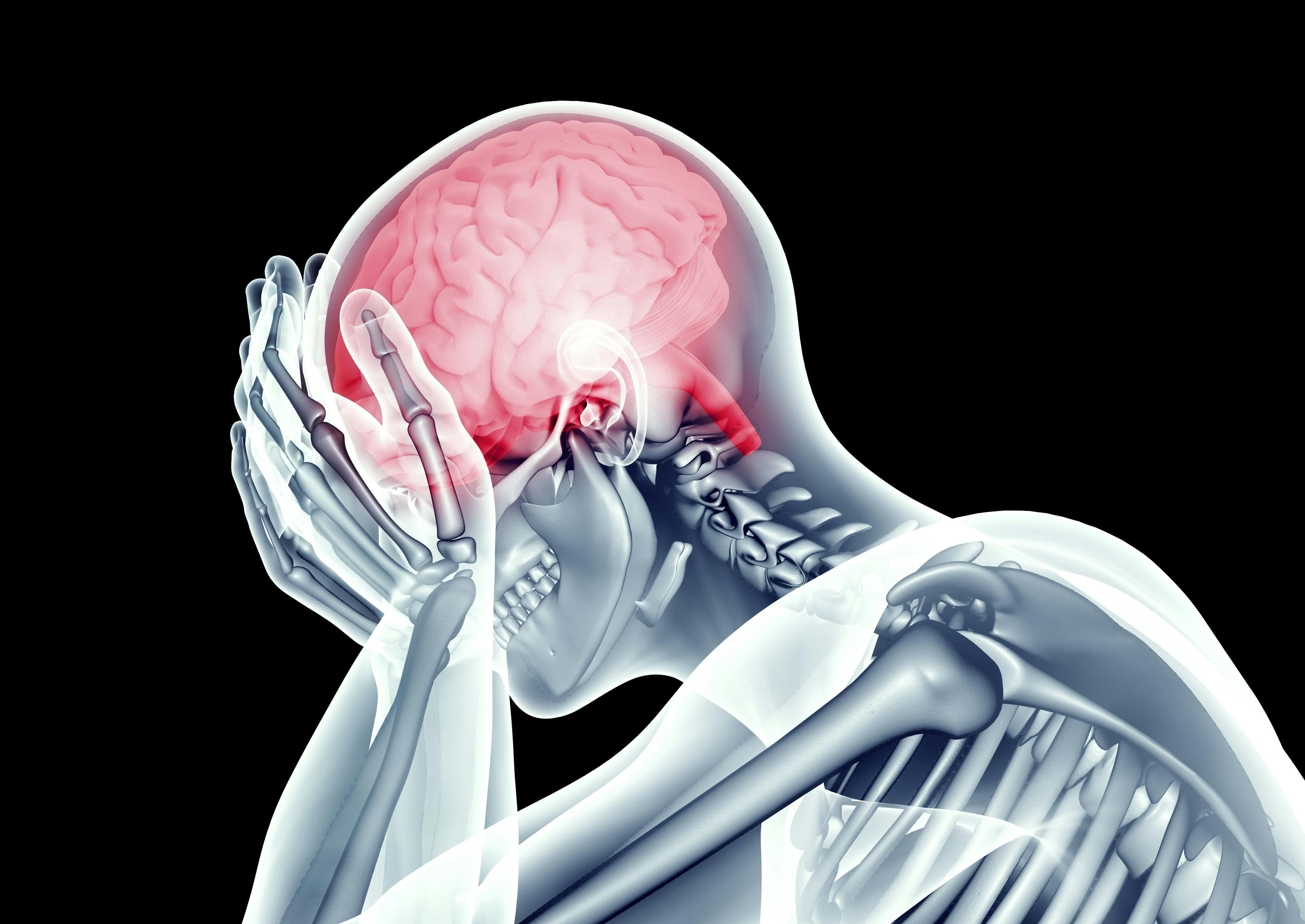 Managing Migraine: From Acute Treatment to CGRPs