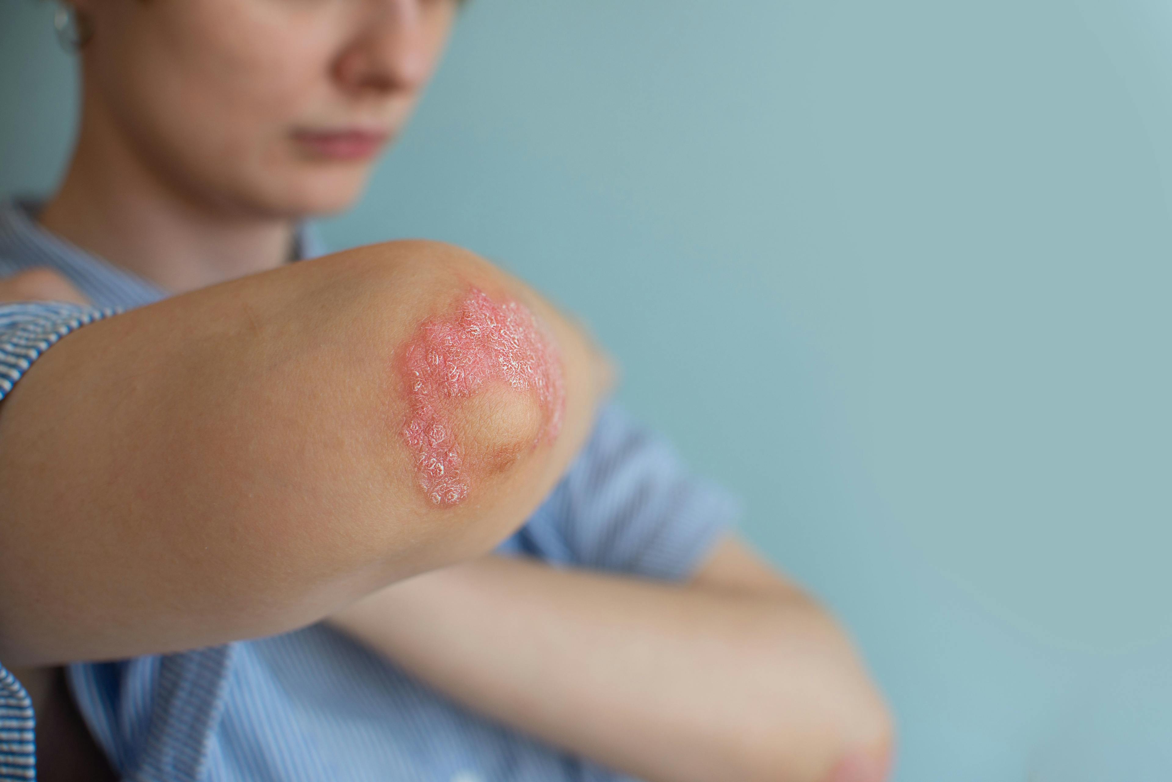 New Approaches in Psoriasis and Psoriatic Arthritis Treatment 