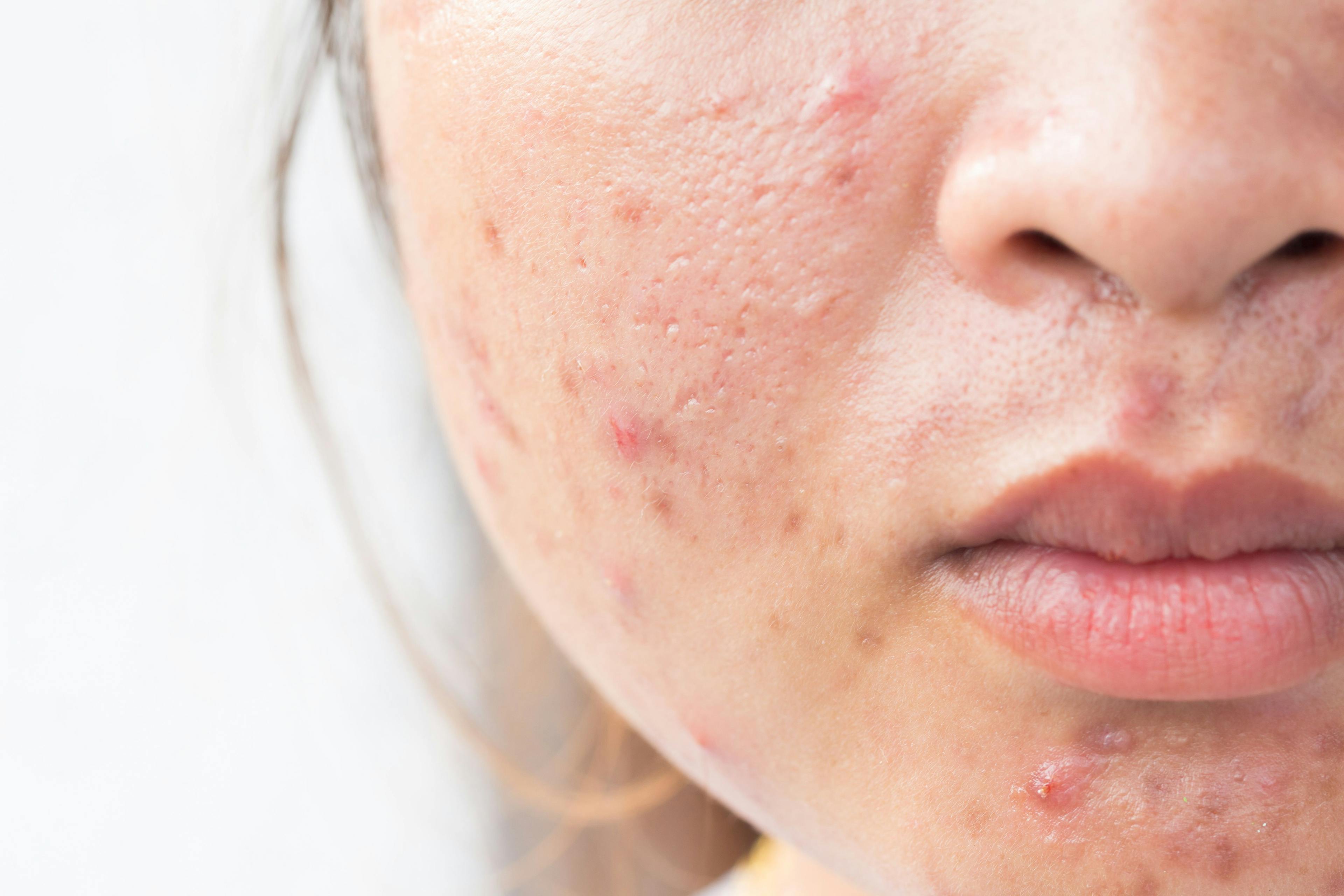Anxiety Identified as Most Prevalent Comorbidity in Patients Using Isotretinoin For Acne