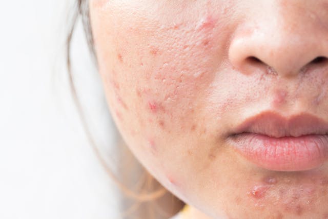 Metformin and Doxycycline Found Equally Effective in Treatment of Acne