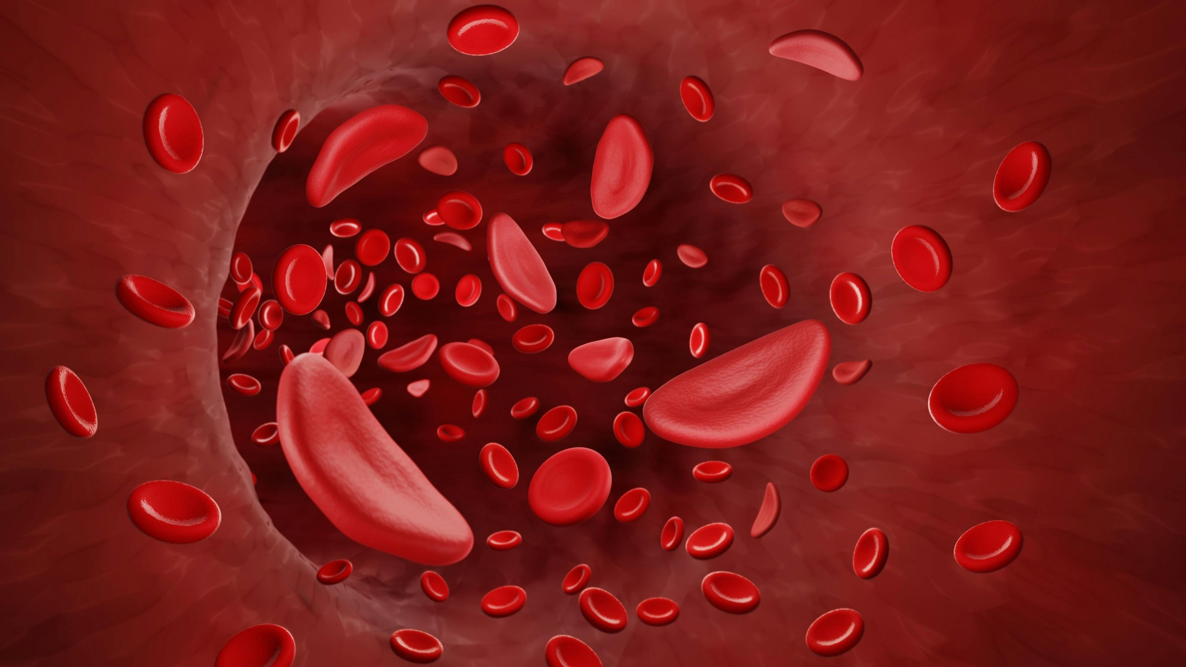 Sickle Cell Disease Finally Getting Its Due