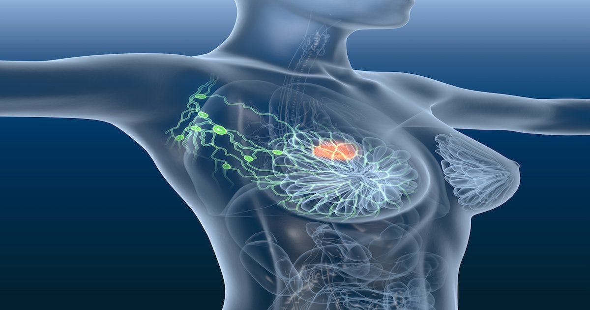FDA Approves Expanded Indication for Adjuvant Abemaciclib in HR+/HER2- Early Breast Cancer