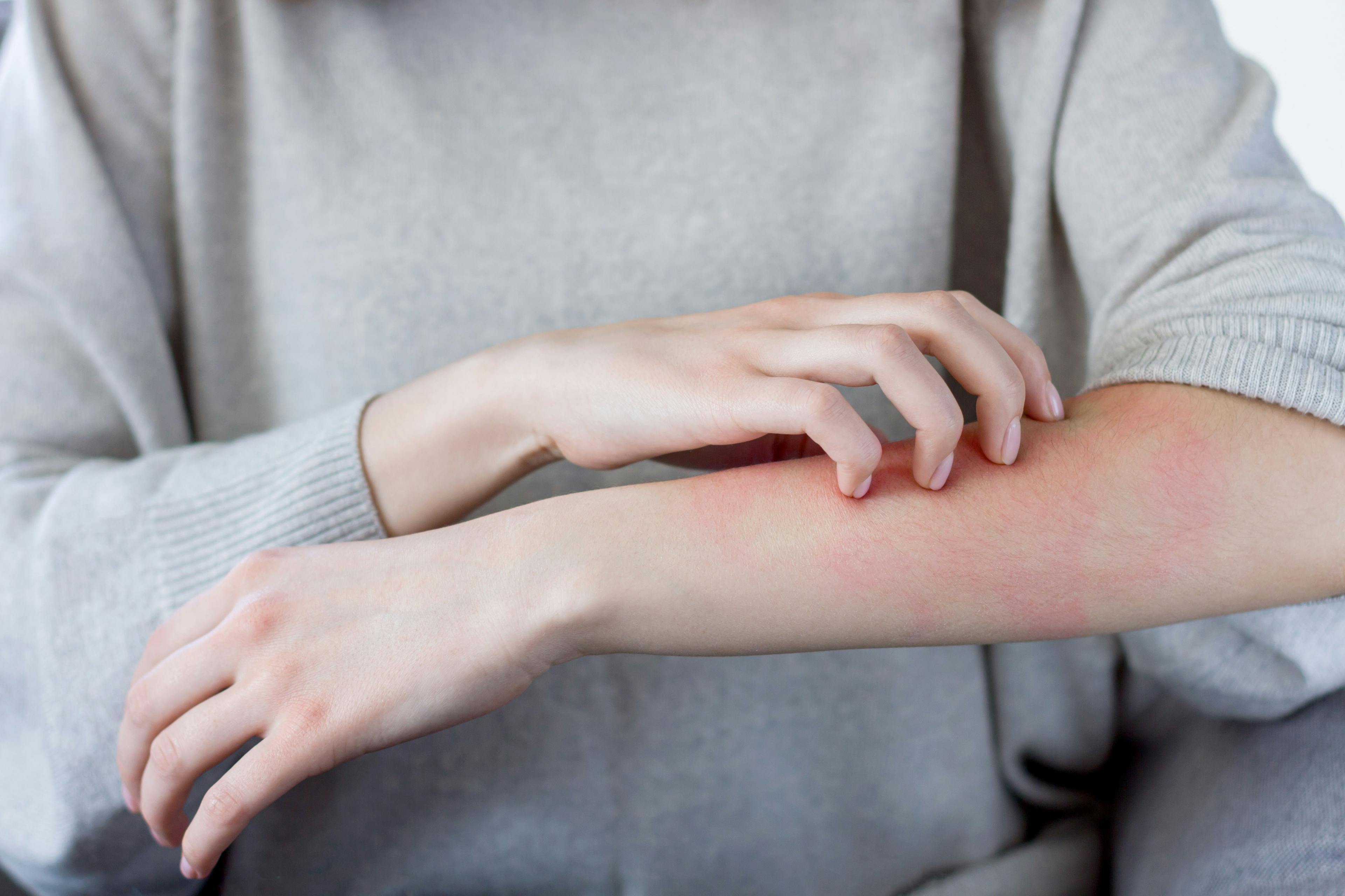 Dupilumab Safe, Effective for Atopic Dermatitis in Real-Life Settings