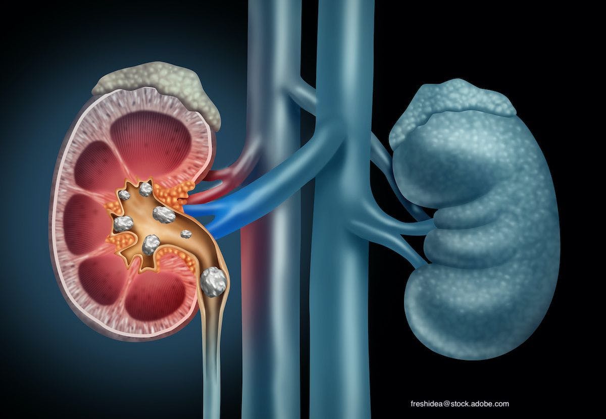 Kidney Stone Risk in T2D Could Be Reduced with Empagliflozin