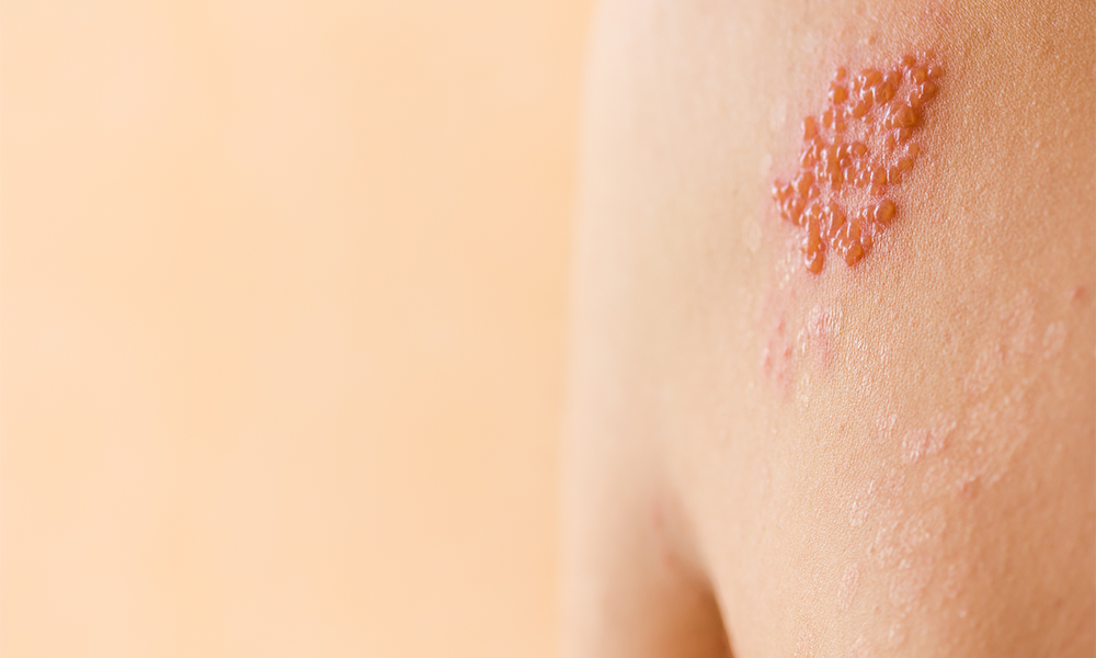 Shingles Herpes Zoster