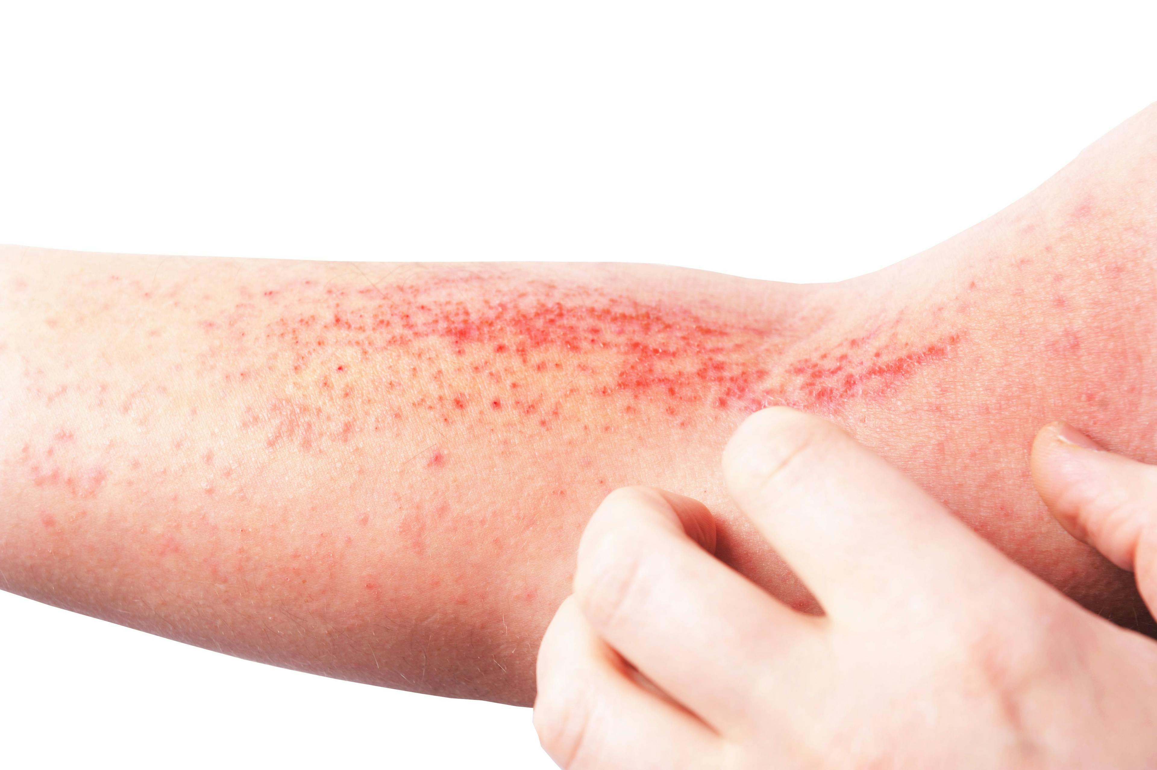 Abrocitinib Approved for Adolescent Atopic Dermatitis 