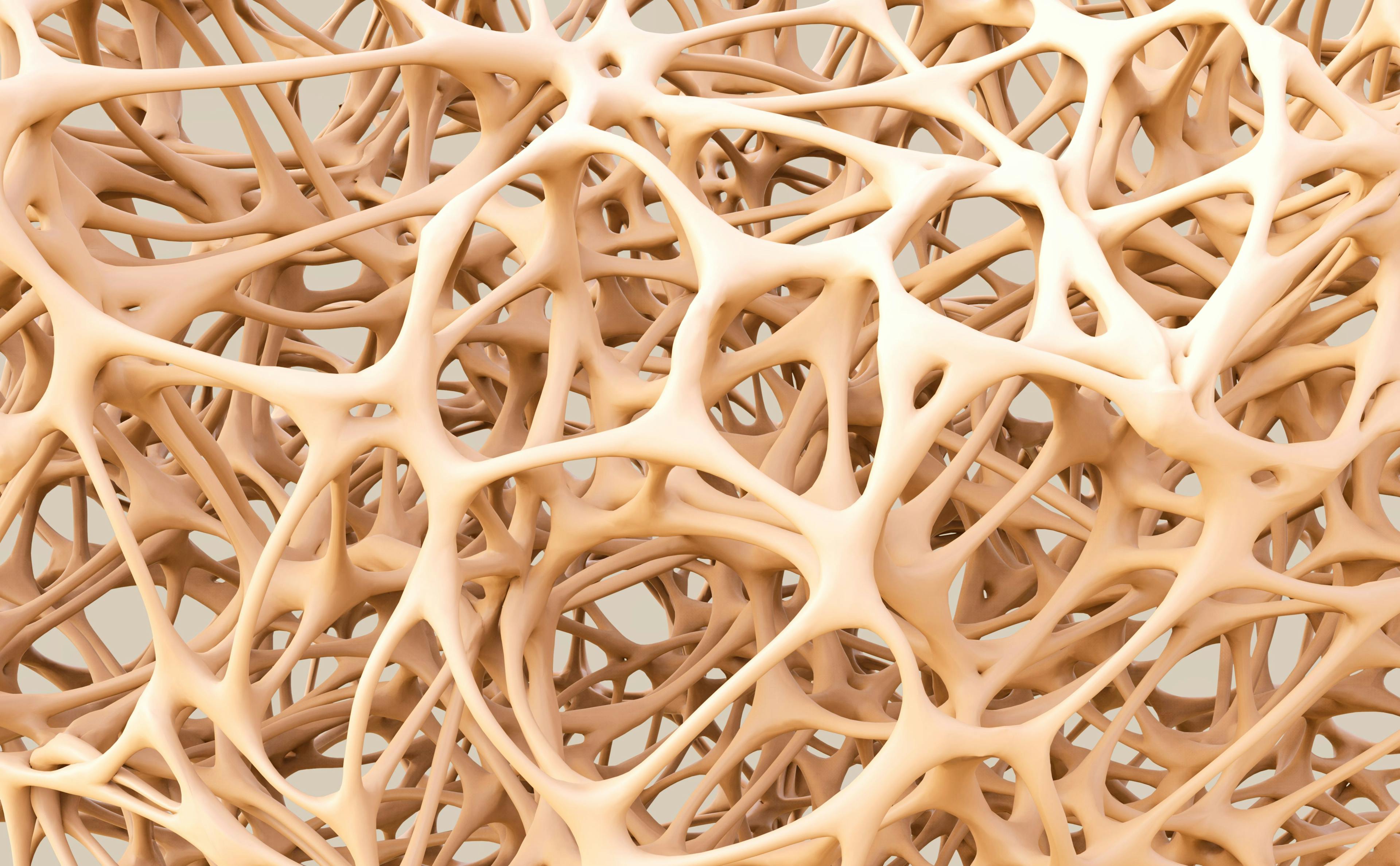 NSAID Use May Reduce Effectiveness of Osteoporosis Therapies