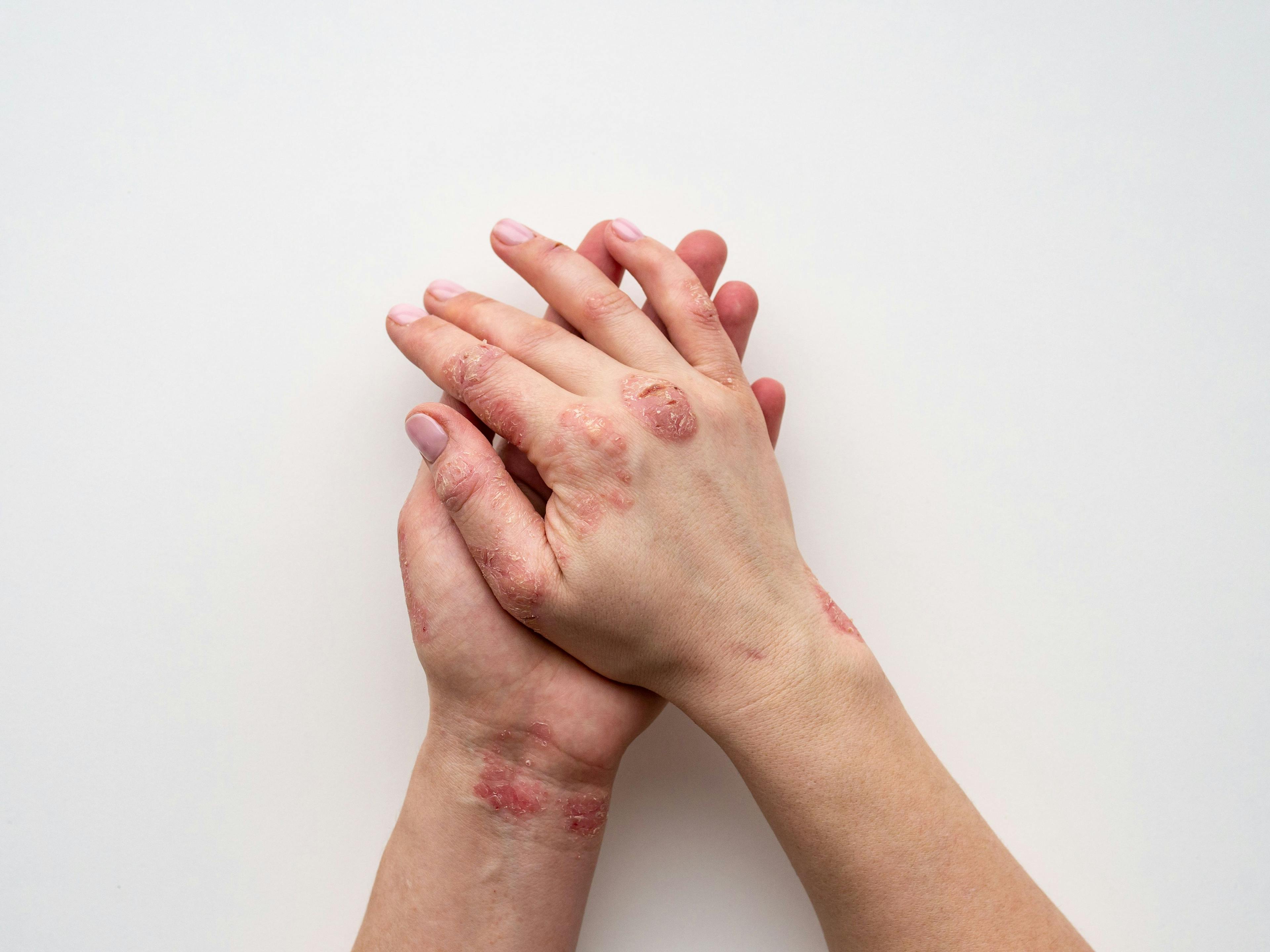 Vitamin D Could Provide Benefit to Patients With Psoriasis