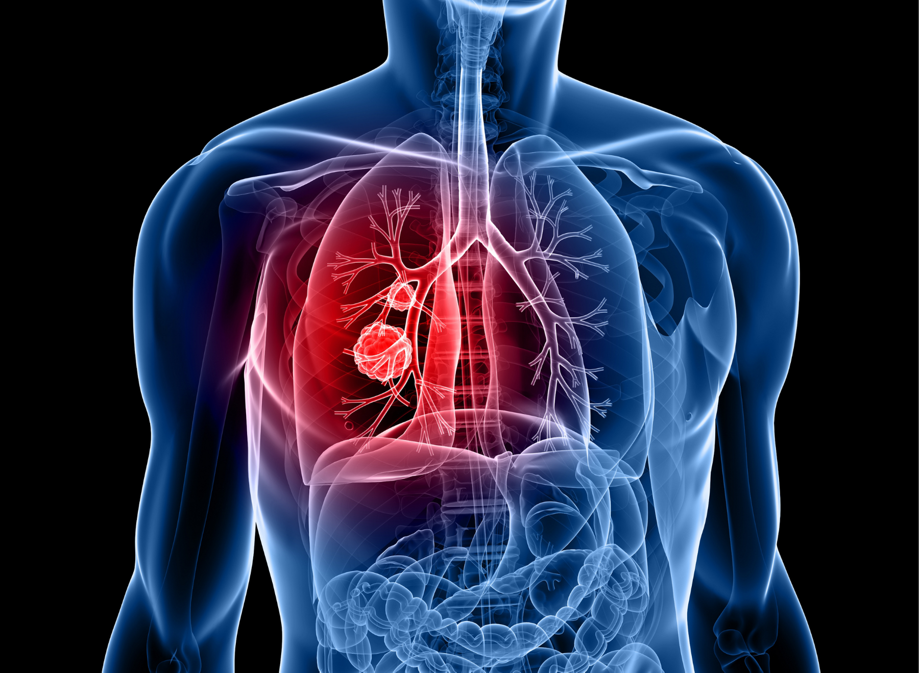 non-small cell lung cancer