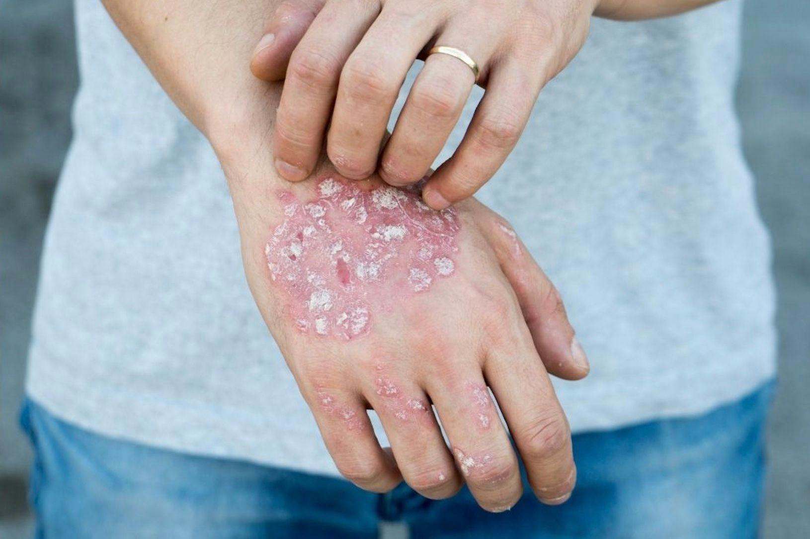 Biologics Offer Great Results in Treating Psoriasis—At a Cost