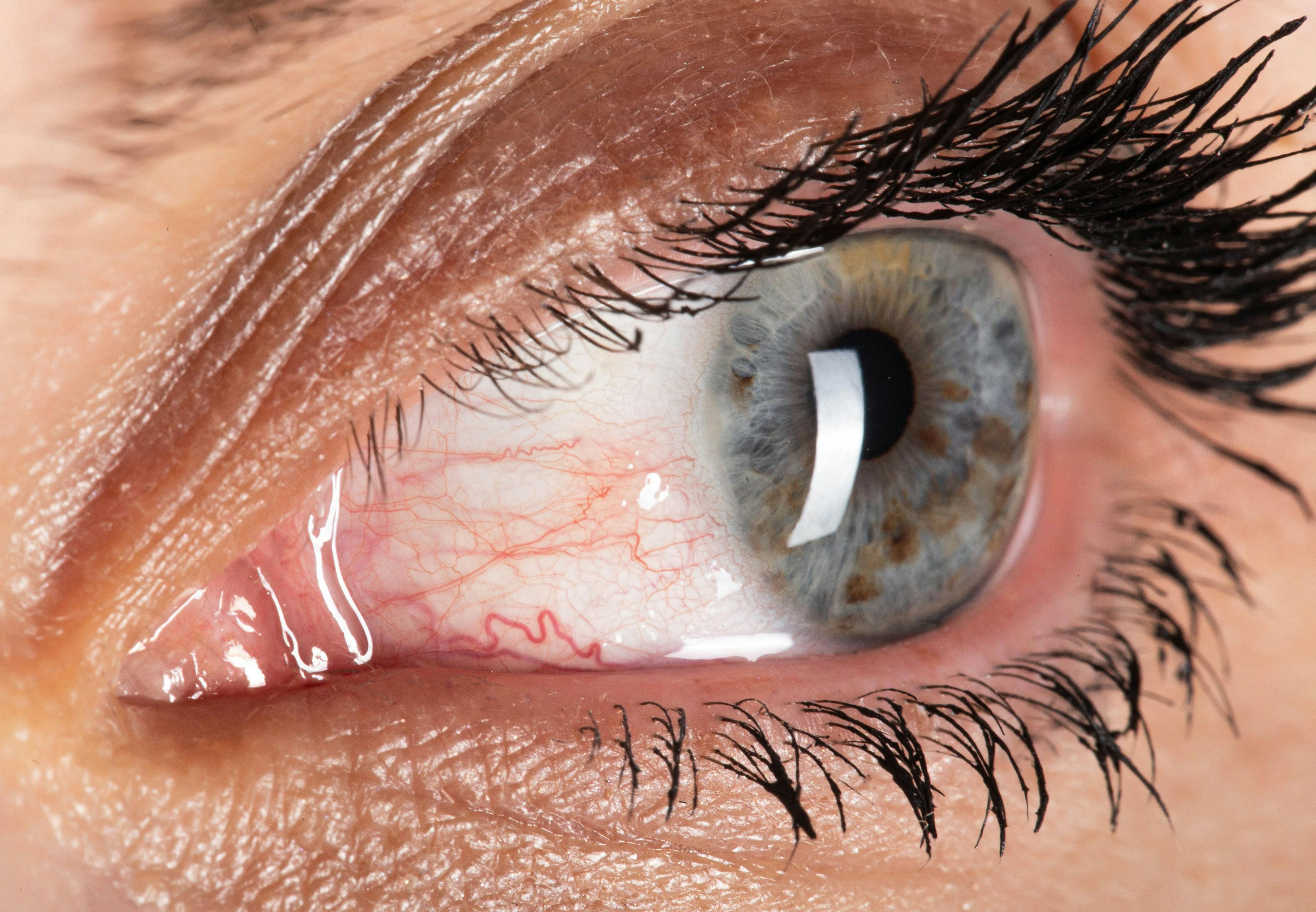 Brepocitinib Shows Positive Results For Treatment of Non-Infectious Uveitis in Phase 2 Study 