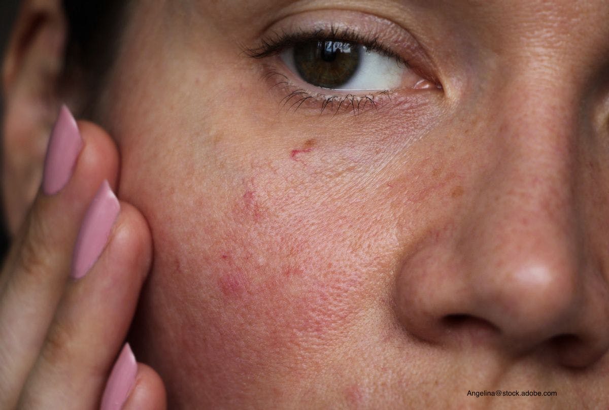 Skin Sensitivity Reported by 71% of Adults