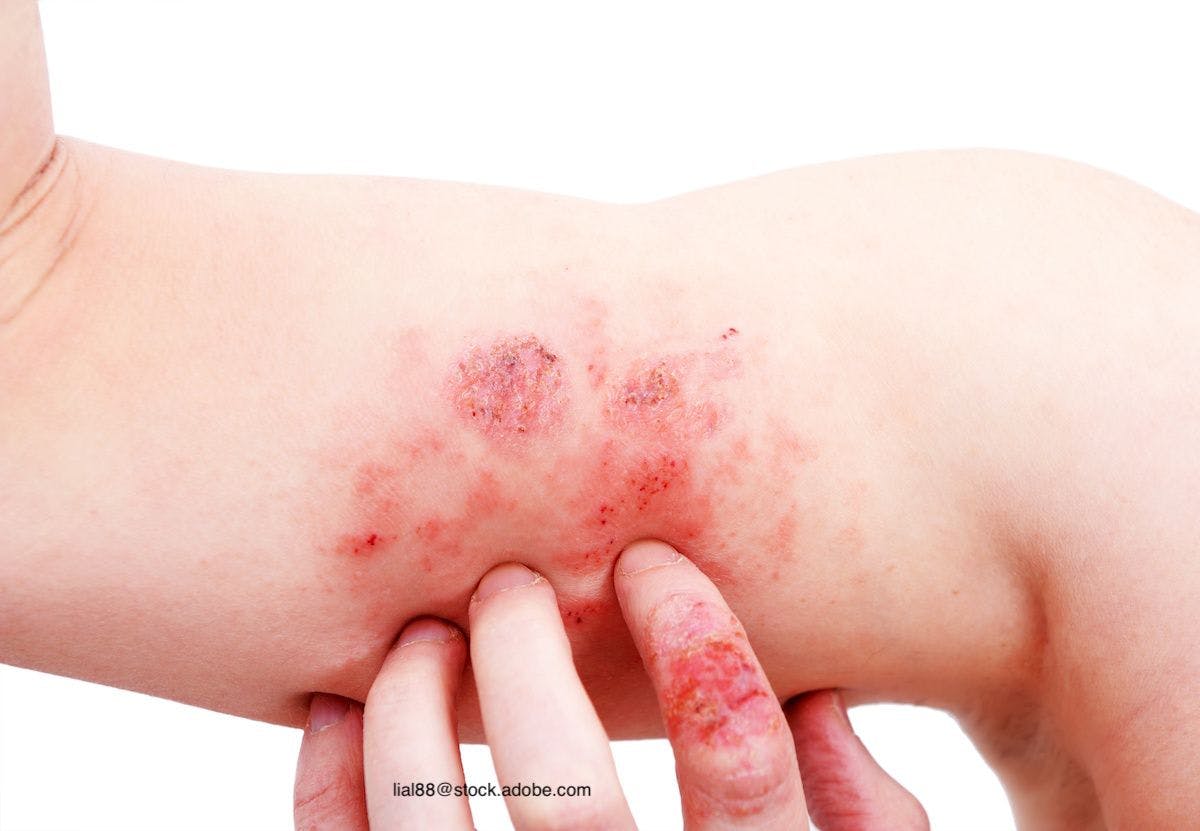 Dupixent Clinical Trial Results for Atopic Dermatitis Bolstered by Real-World Evidence