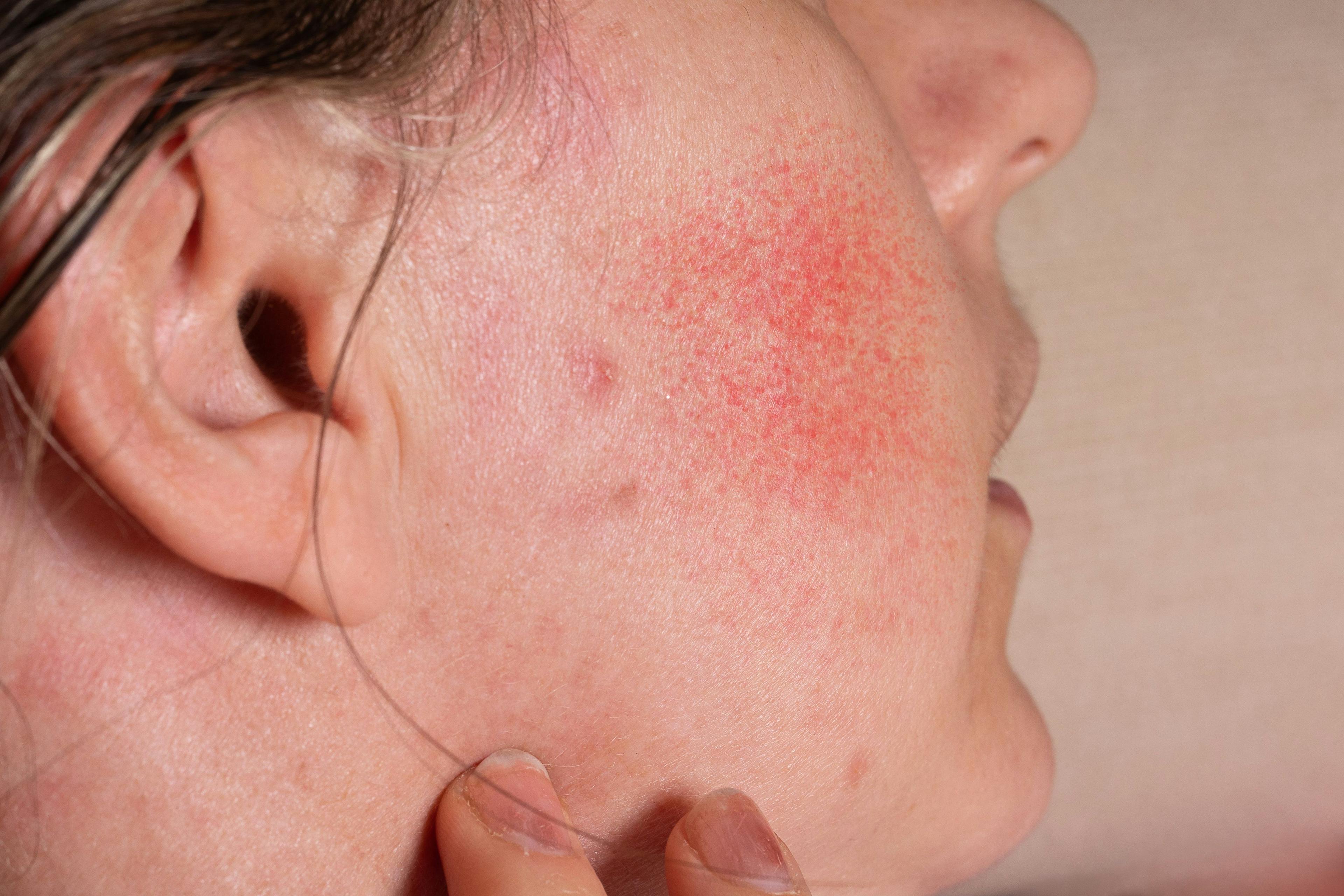 What’s New in Acne and Rosacea? 