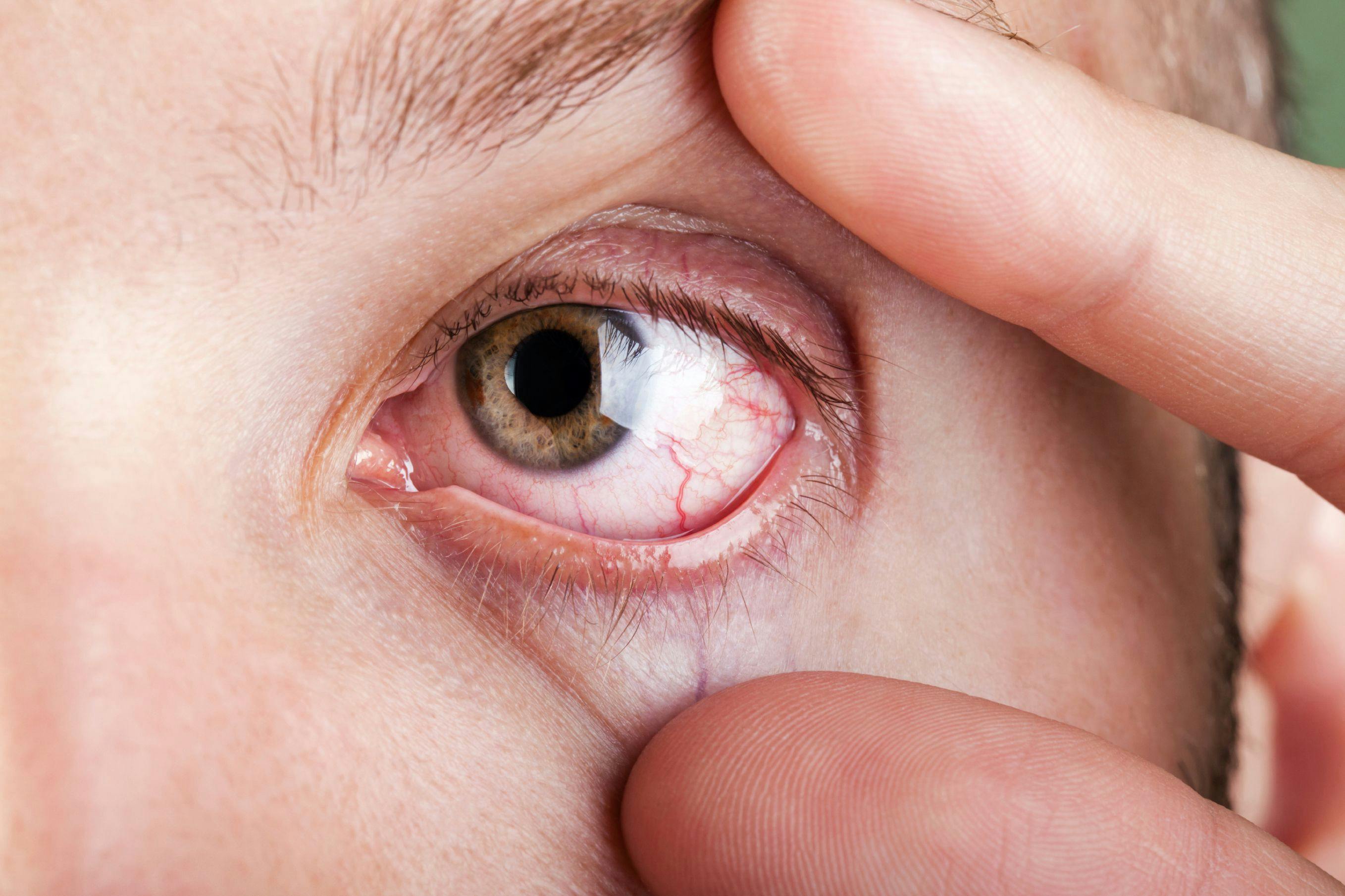 Dry Eye Linked to Poor Sleep Quality