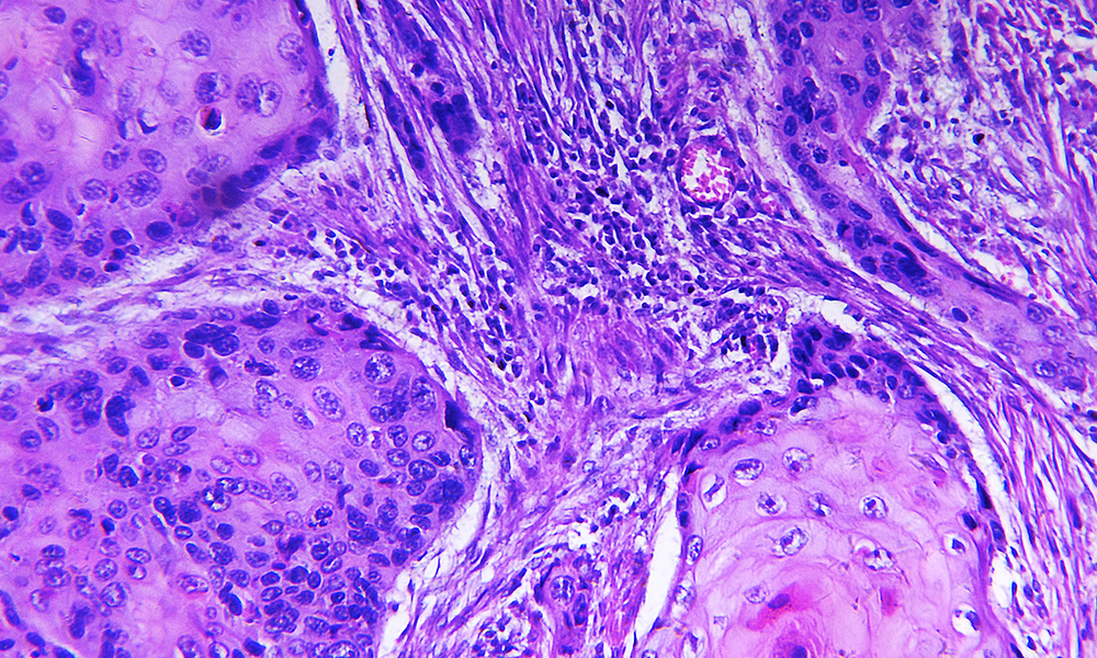 scquamous cell carcinoma slide