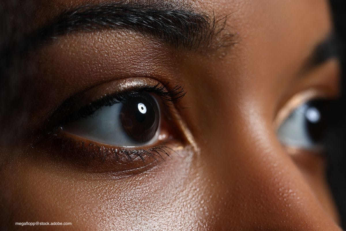 Black Patients Have Higher Risk of Vision Loss After Glaucoma Diagnosis