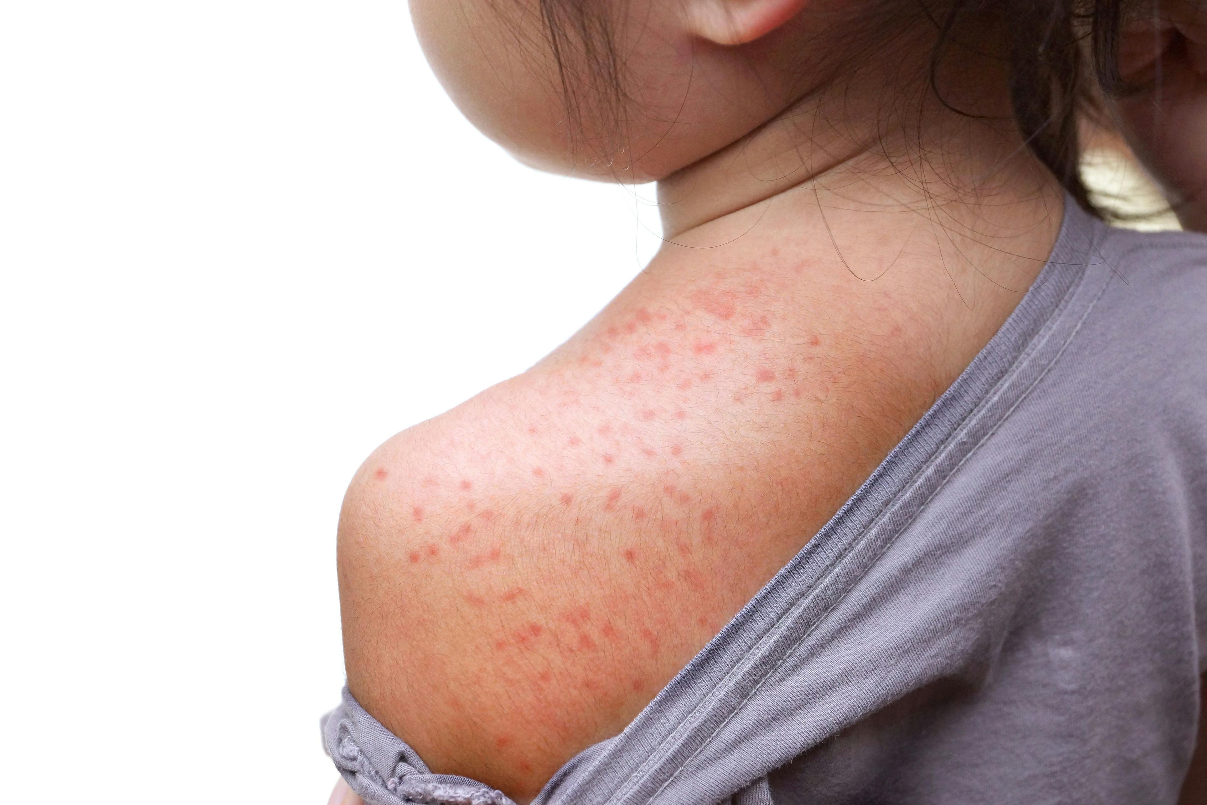 Measles rash on shoulder / weerapat1003 - stock.adobe.com
