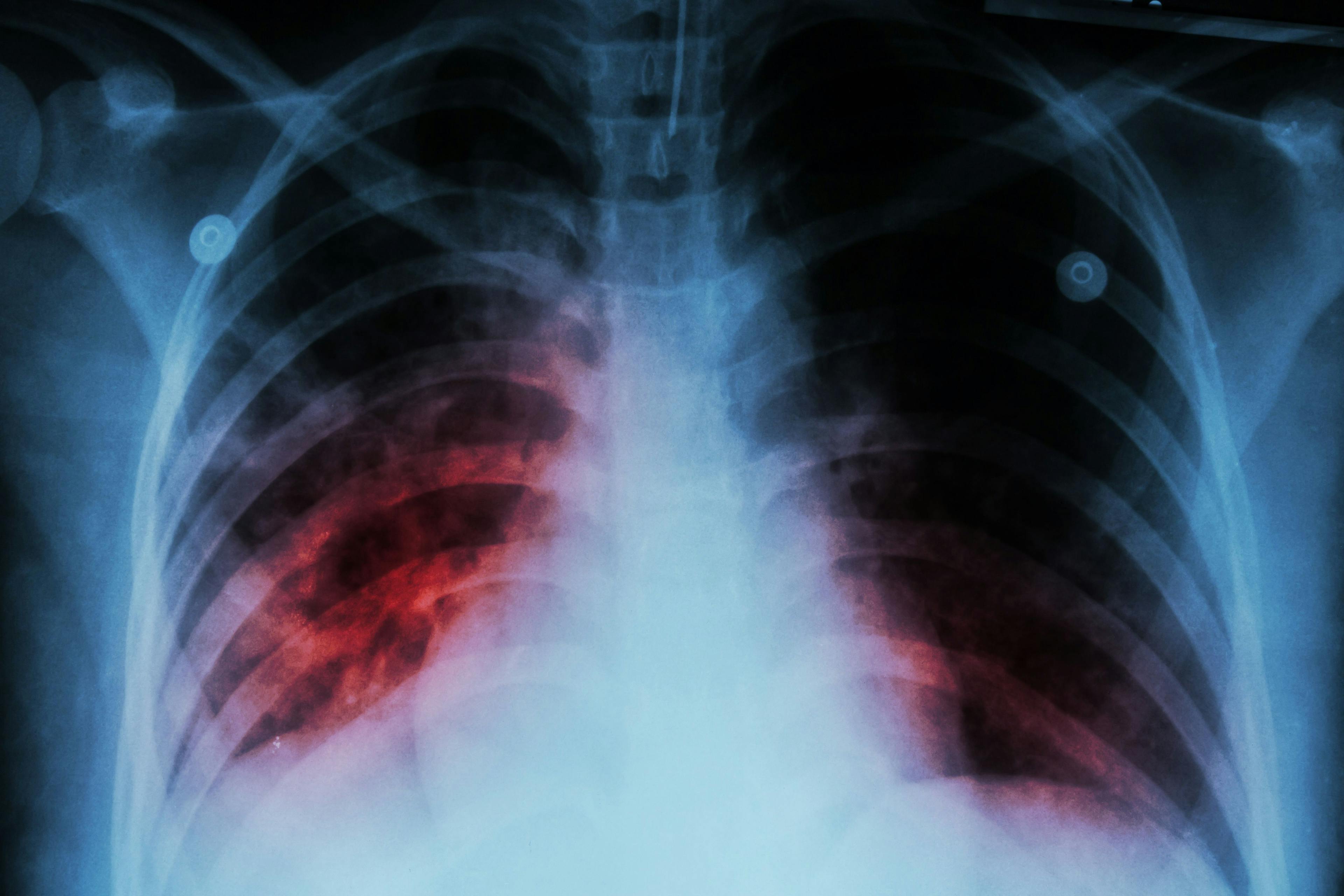 Pneumonia and Tuberculosis Rates Higher In Individuals Who Used Inhaled Corticosteroids