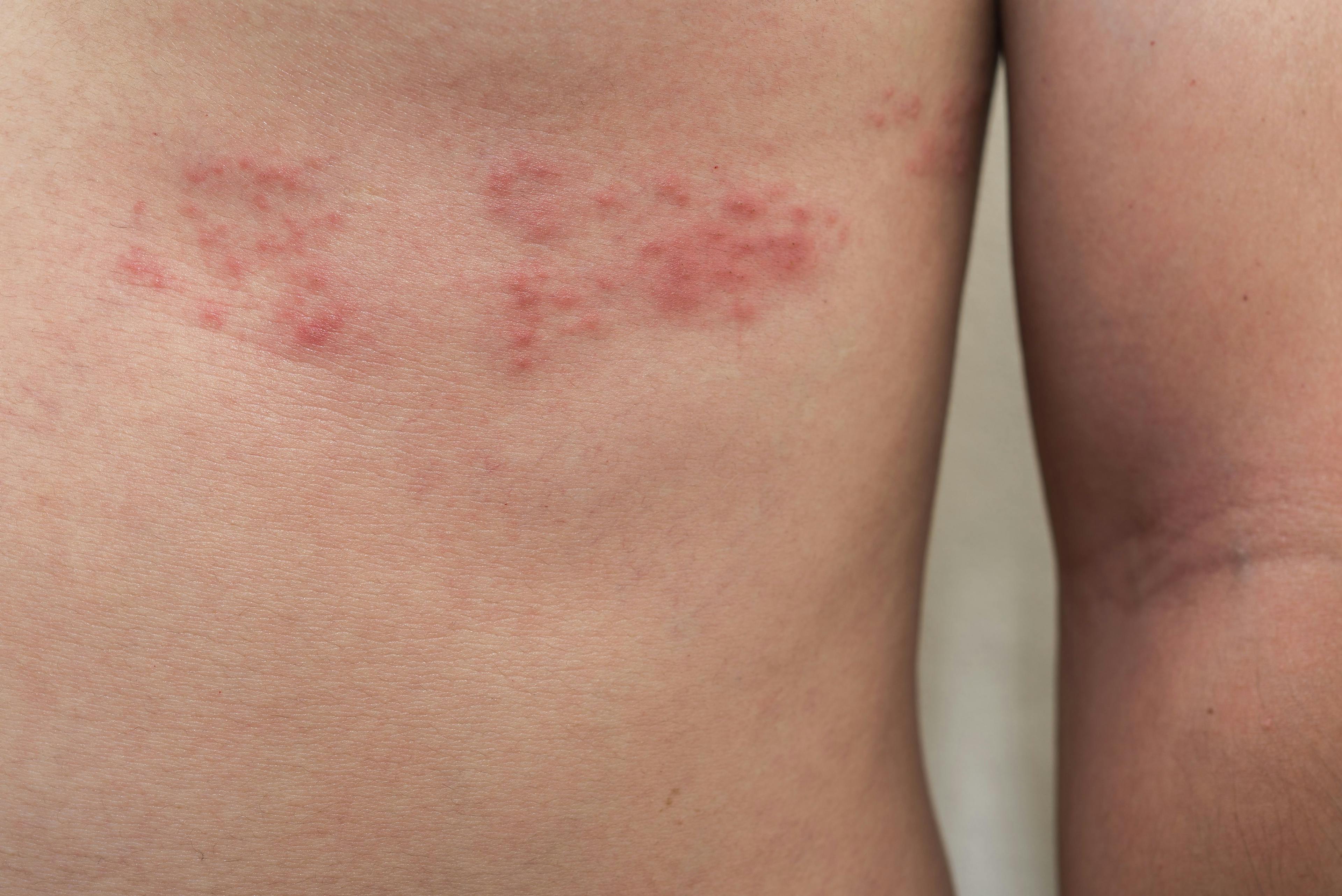 shingles rash on abdomen | Image credit: Sunday Cat Studio - stock.adobe.com