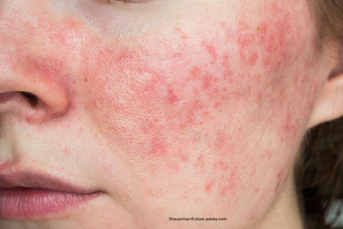 Examining Treatment Options for Rosacea and Acne