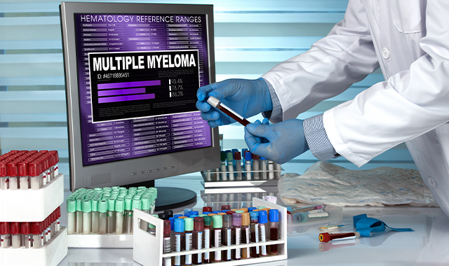 Doctor examining blood samples multiple myeloma