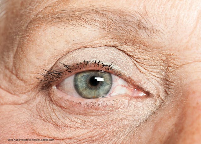 Two Eye Diseases Could Contribute to Common Blinding Eye Condition