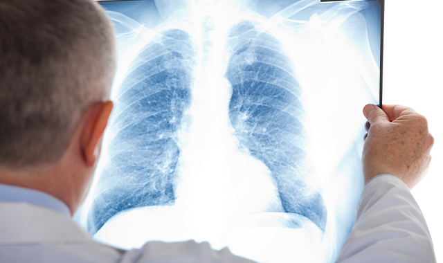 Doctor observing lung radiography