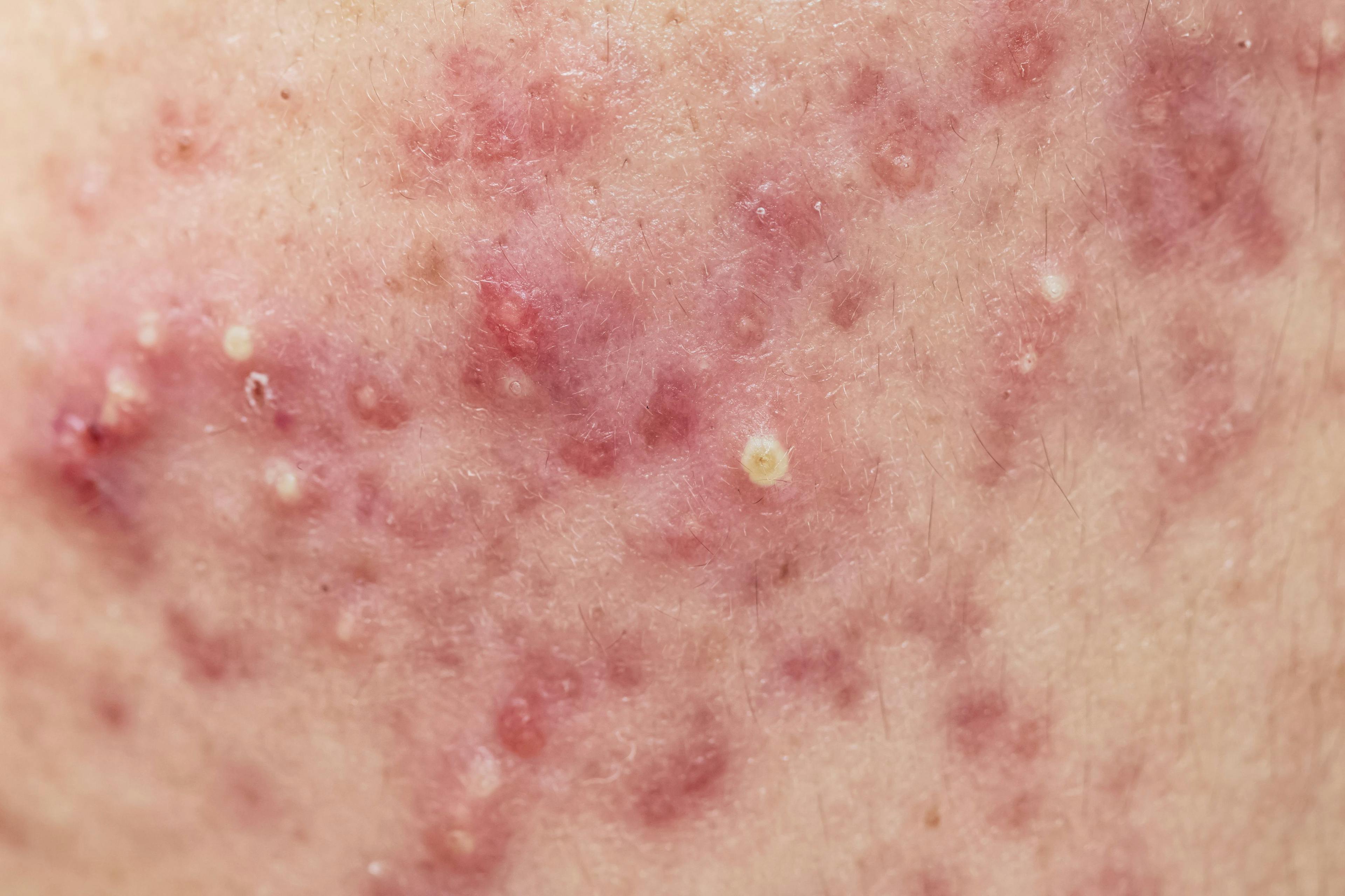Adverse Events of ALA-PDT Treatment for Acne Evaluated