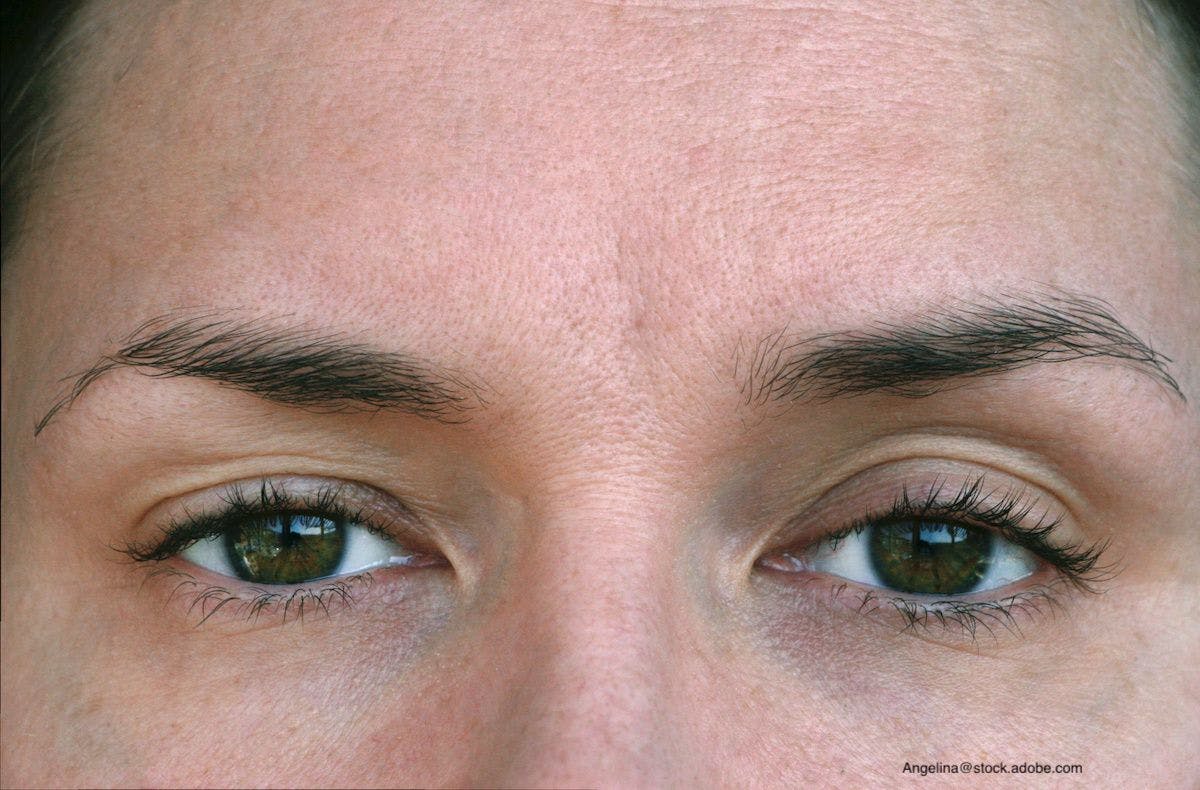 Researchers Detail First Use of Glaucoma Drug for Eyelid Ptosis After Botox