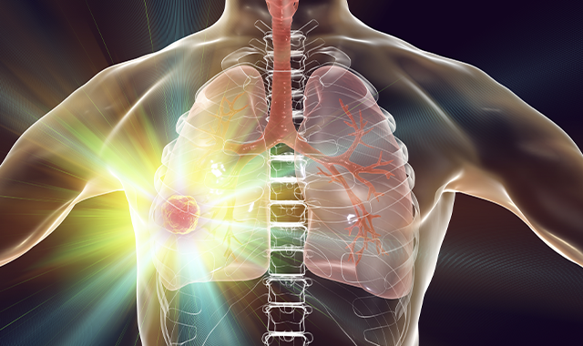 lung cancer 3d rendering