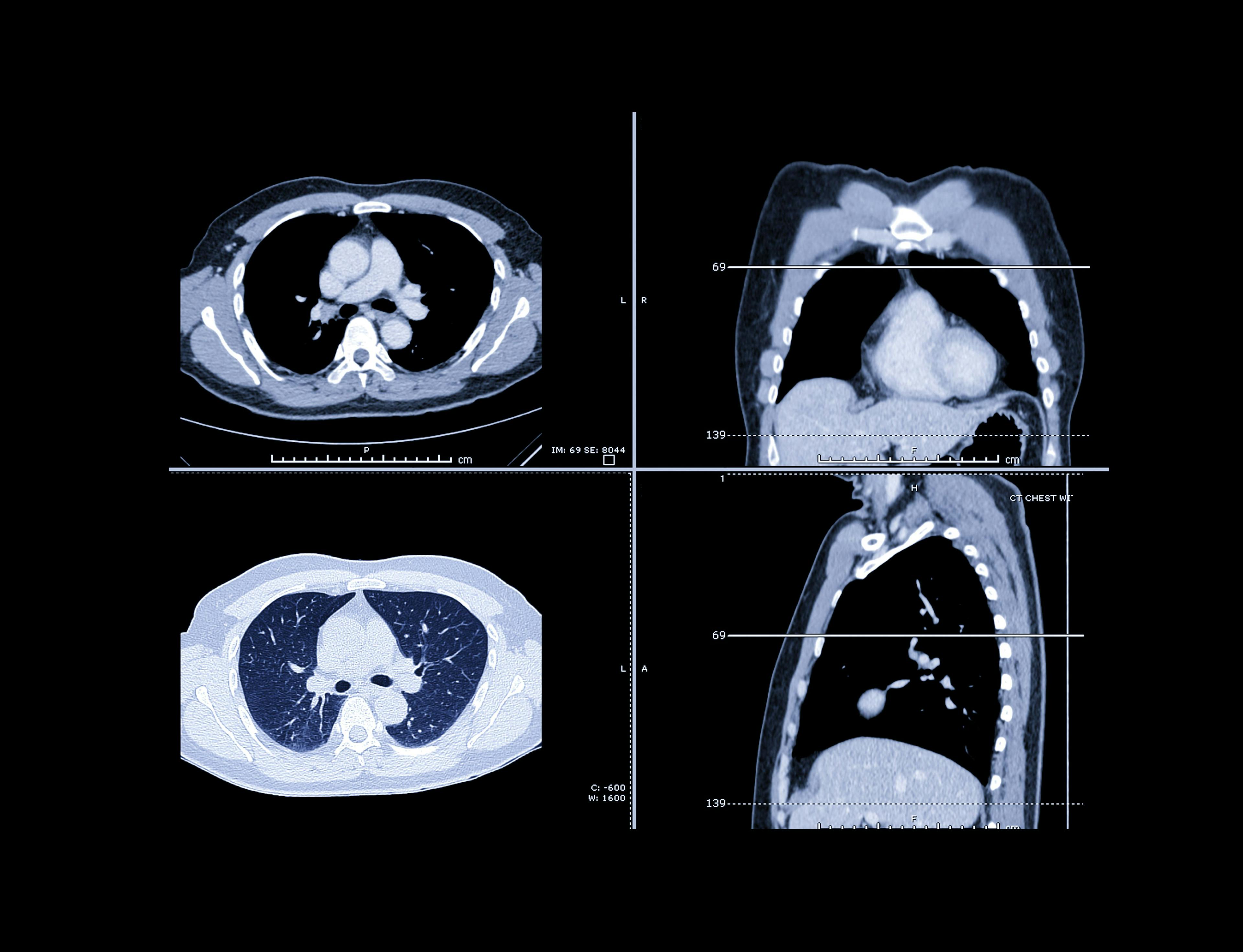 Early CT Screening Linked to Improved Lung Cancer Survival