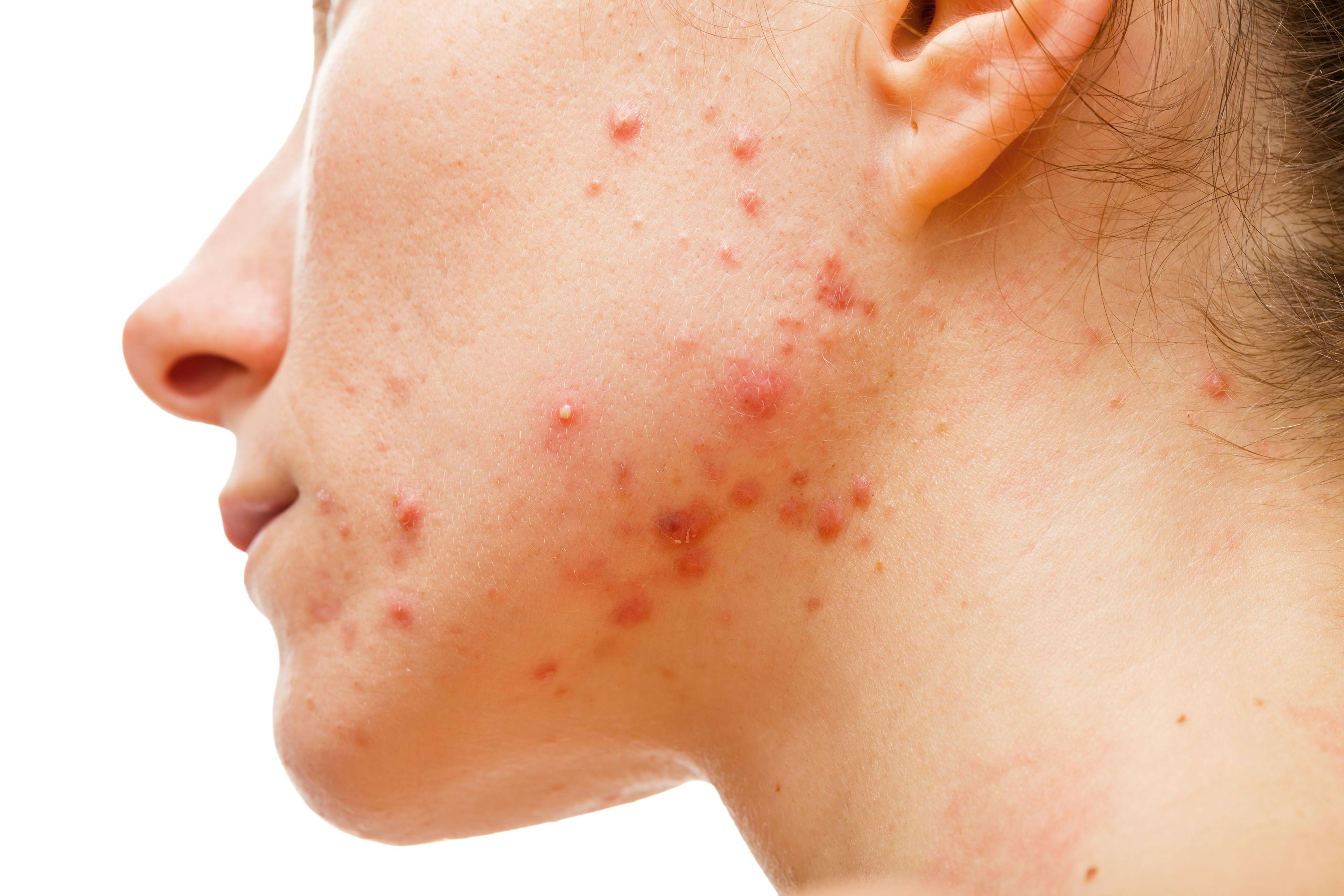 Does CBD Play a Role in Acne Treatment? 