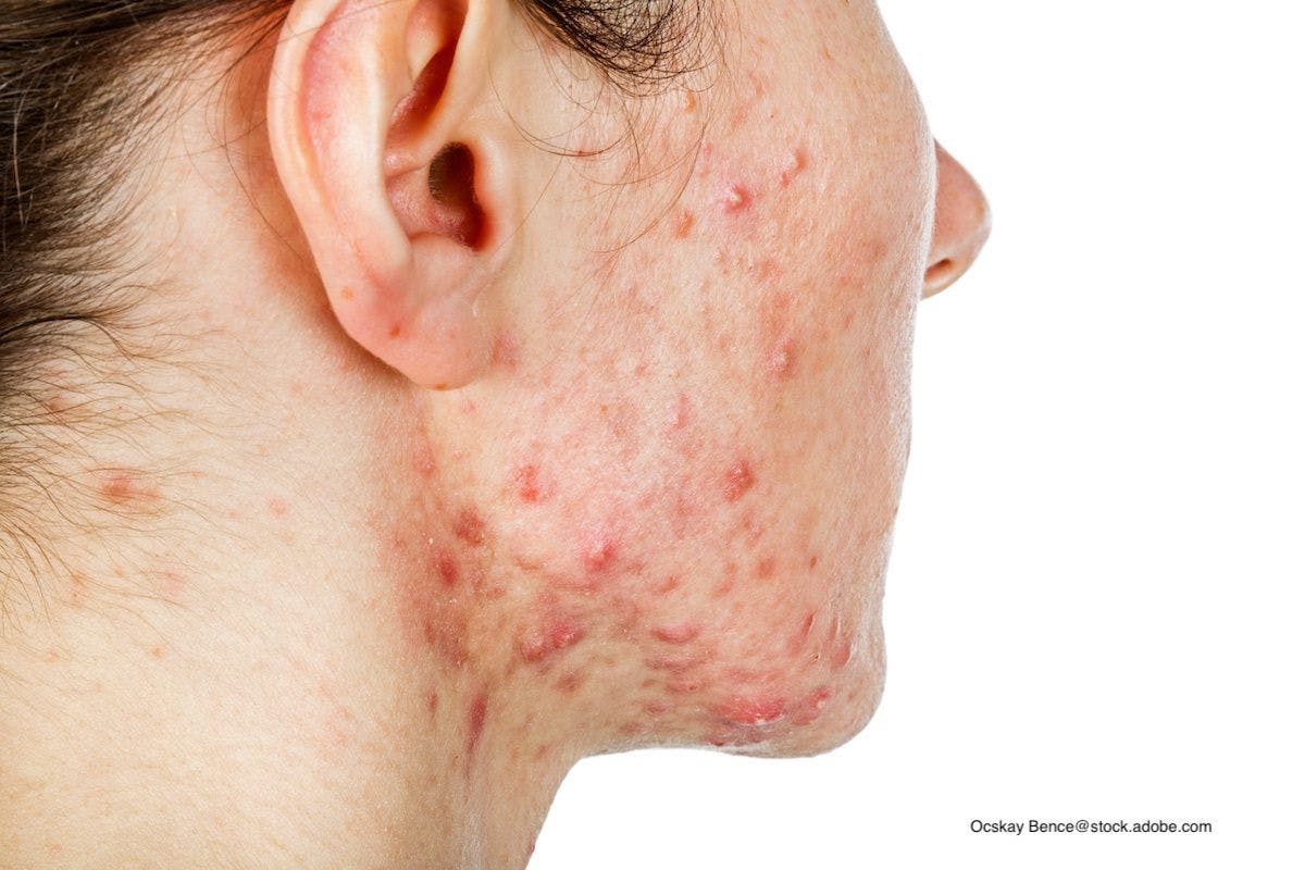 Examining the Safety and Efficacy of Oral Zinc and Low-Dose Isotretinoin for Acne Vulgaris