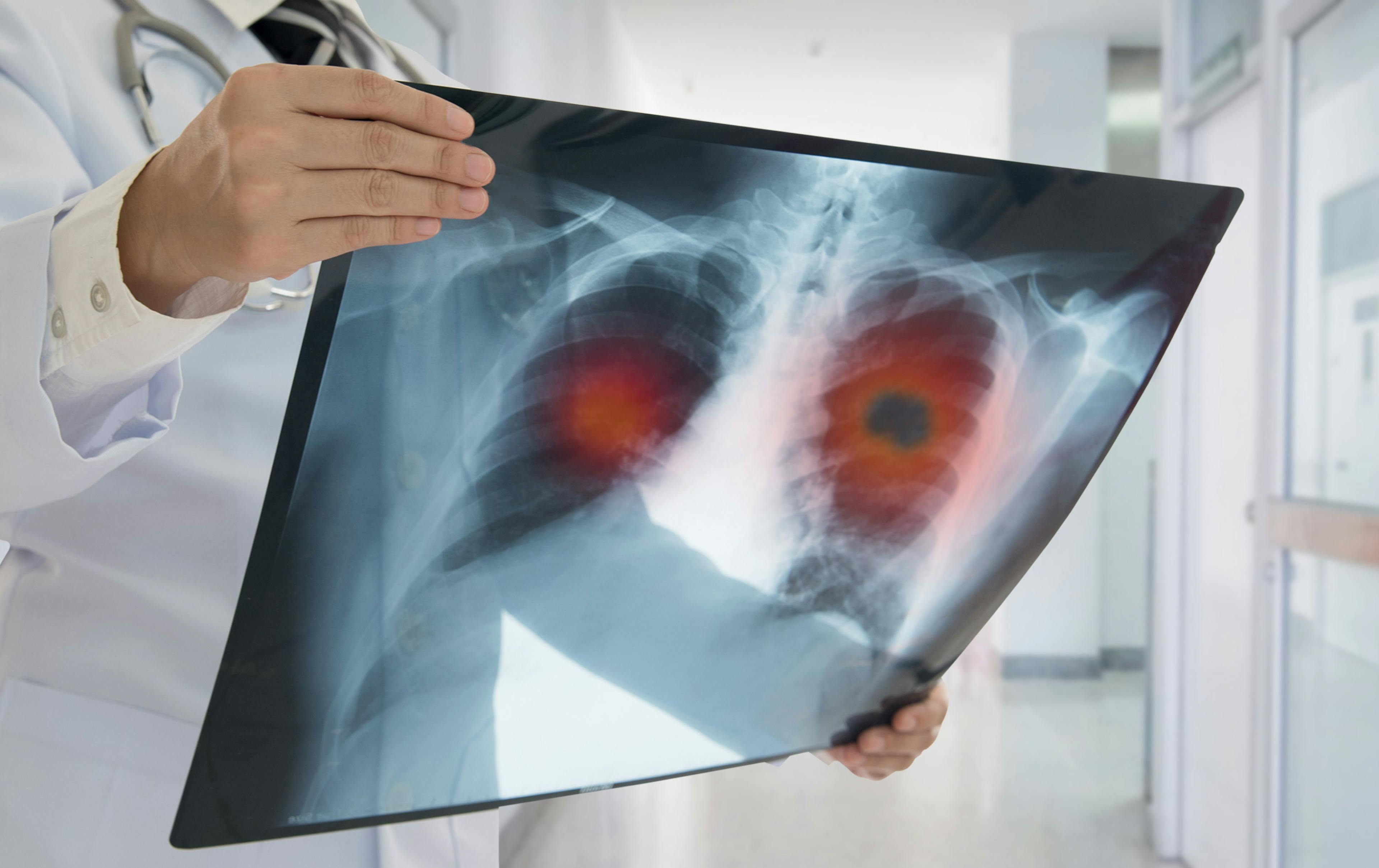 Increased Risk for Lung Cancer May Be Linked With Metabolic Syndrome