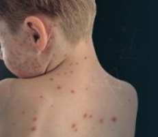 Measles Resurgence in the United States