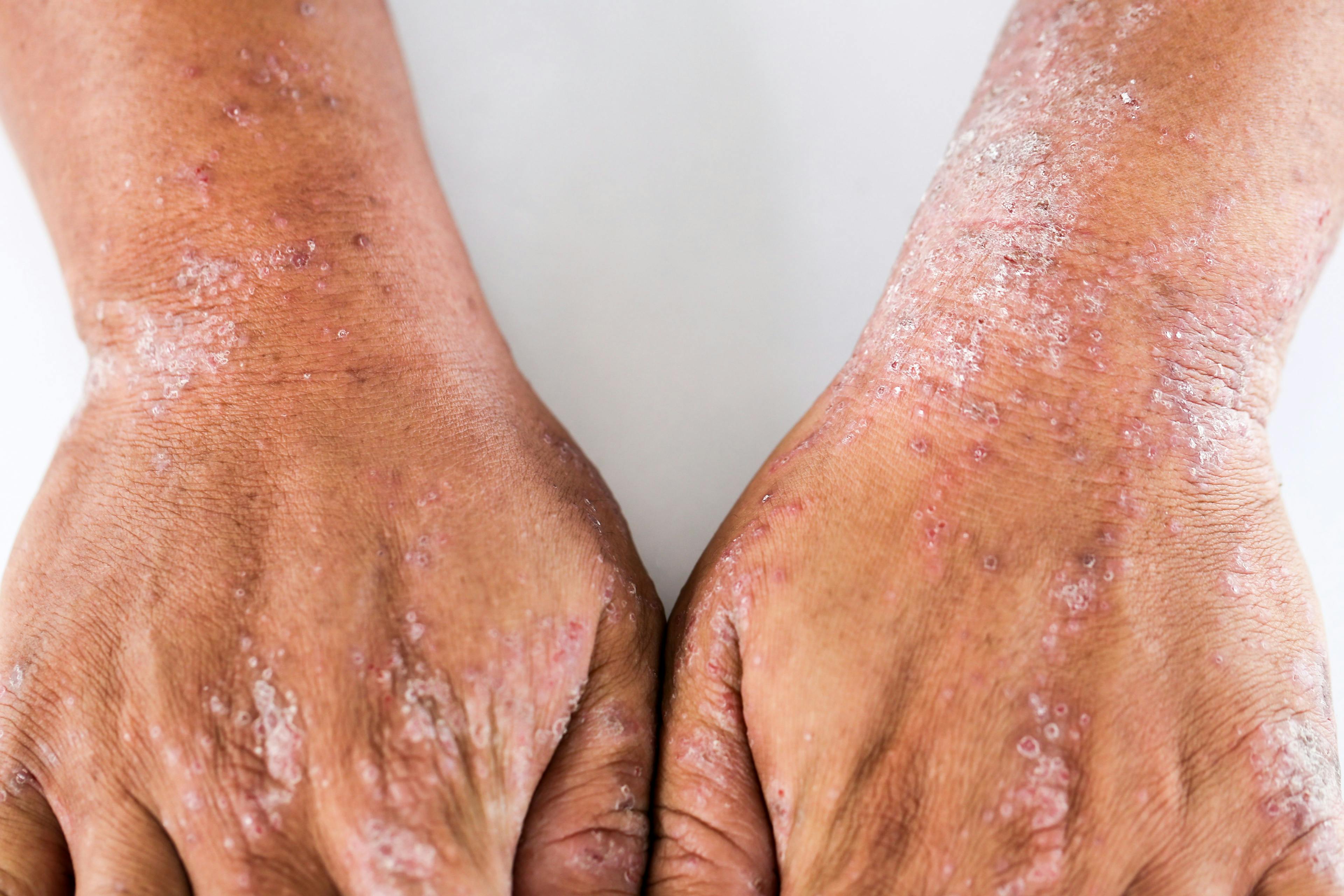 Efficacy of Tapinarof Cream 1% Demonstrated in Atopic Dermatitis in Skin of Color