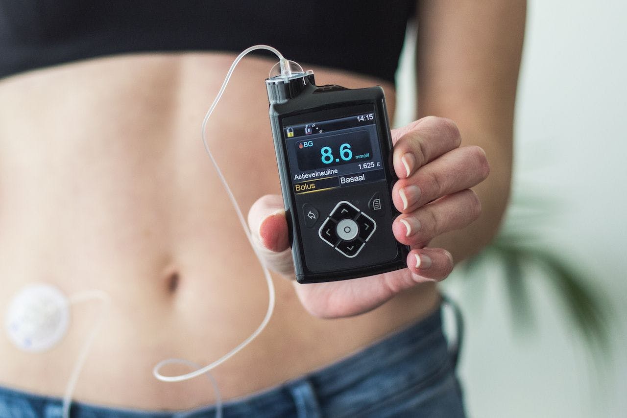 woman holding an insulin pump | Image credit: CottonCandyClouds - stock.adobe.com