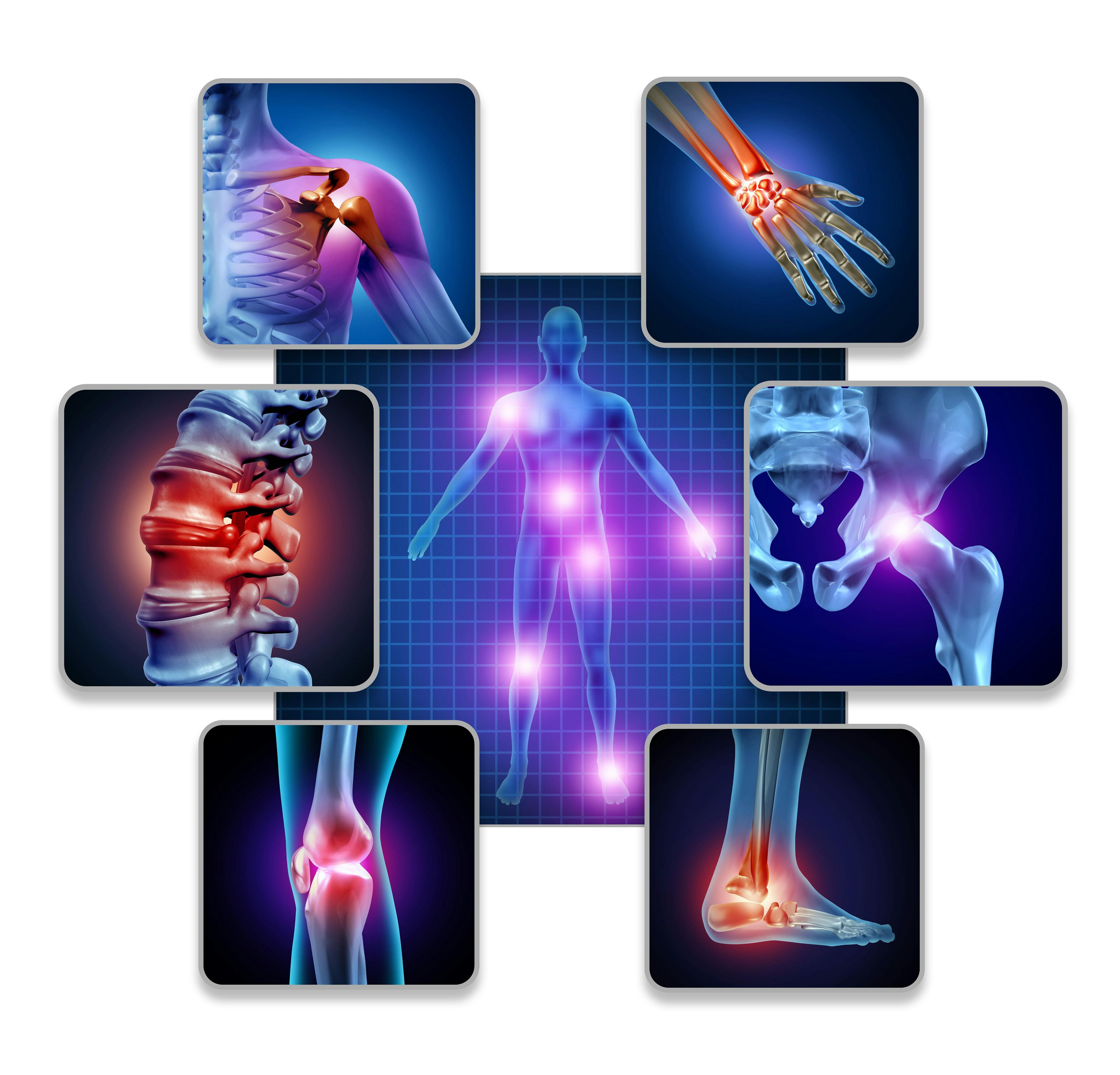 OTC Review: Treatment Options for Osteoarthritis